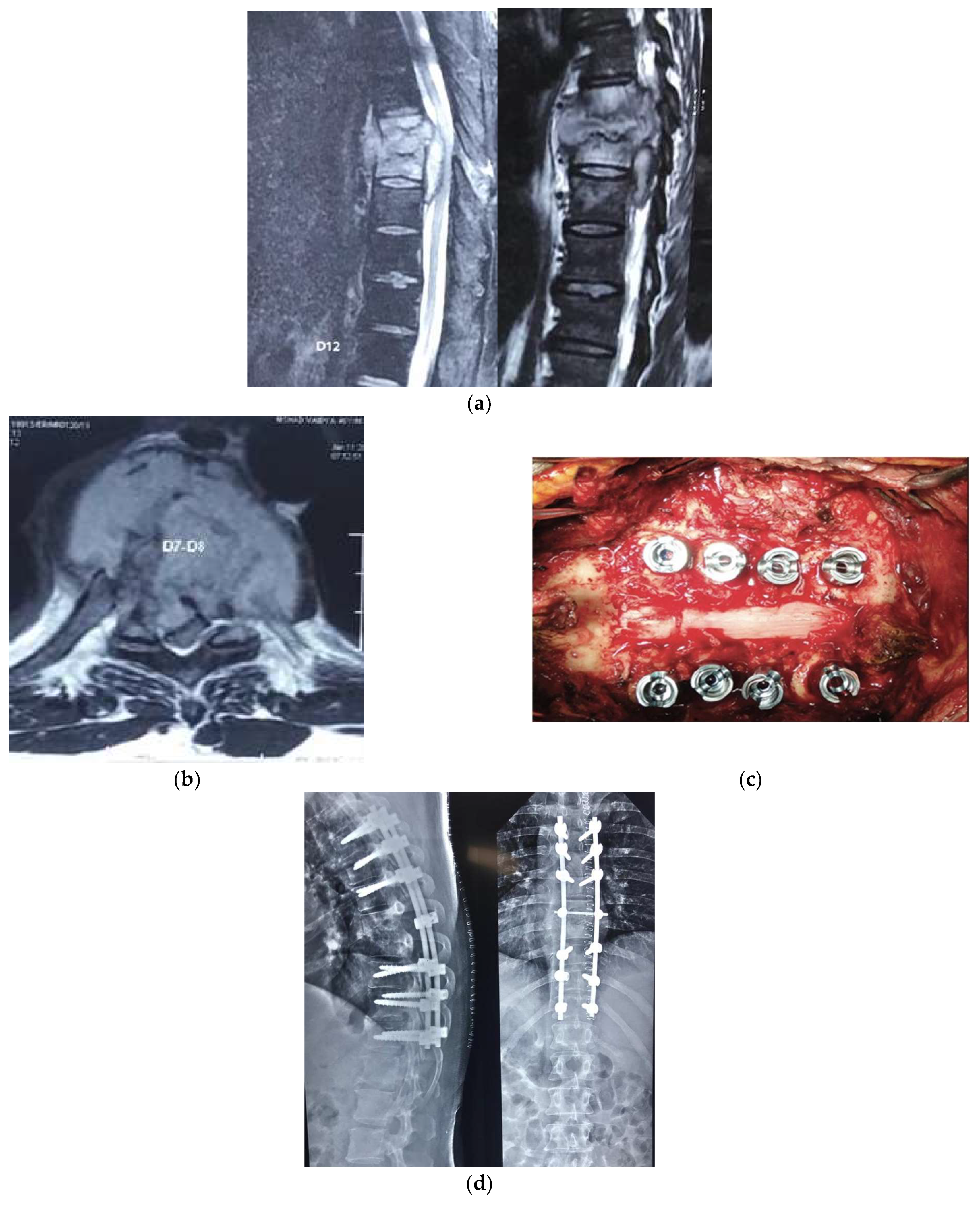 MRI of the dorso-lumbar spine showing a partial collapse of the D12