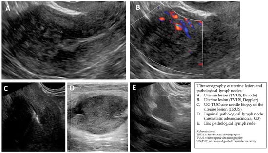 baseline vaginal ultrasound