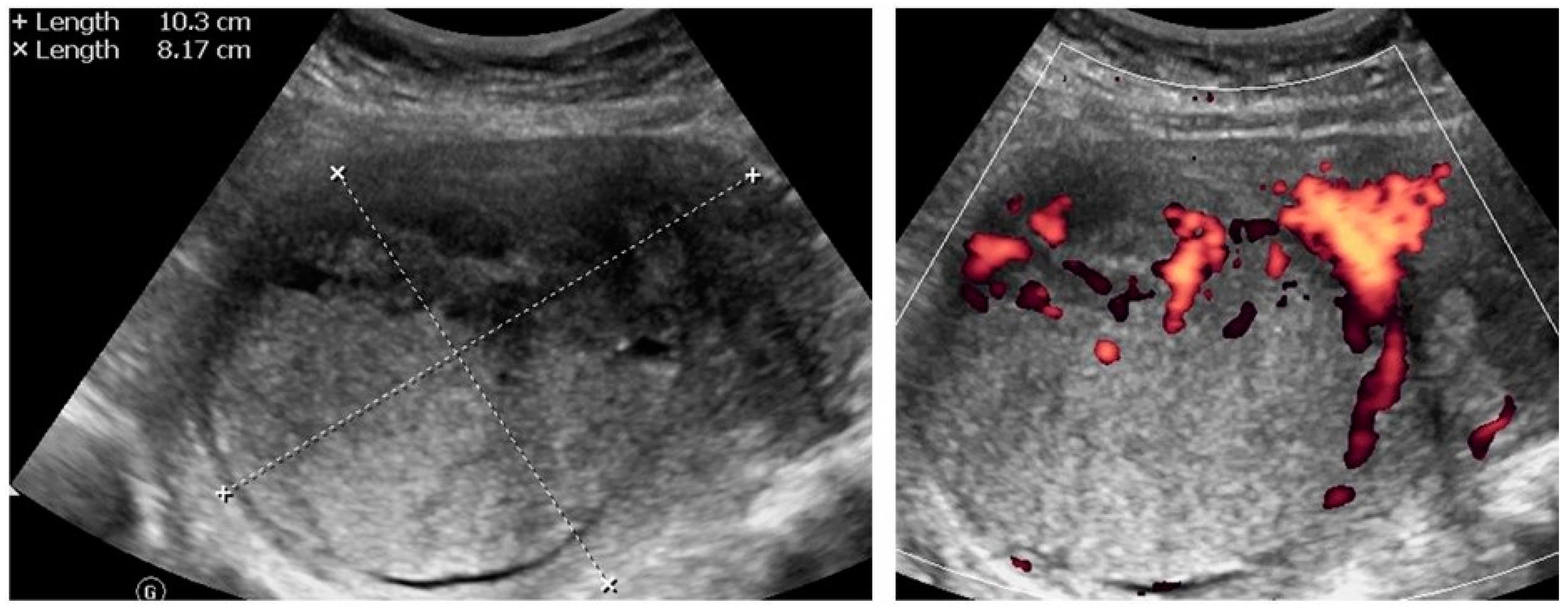 Diagnostics | Free Full-Text | Ultrasound-Guided Trans-Uterine Cavity Core  Needle Biopsy of Uterine Myometrial Tumors to Differentiate Sarcoma from a  Benign Lesion&mdash;Description of the Method and Review of the Literature