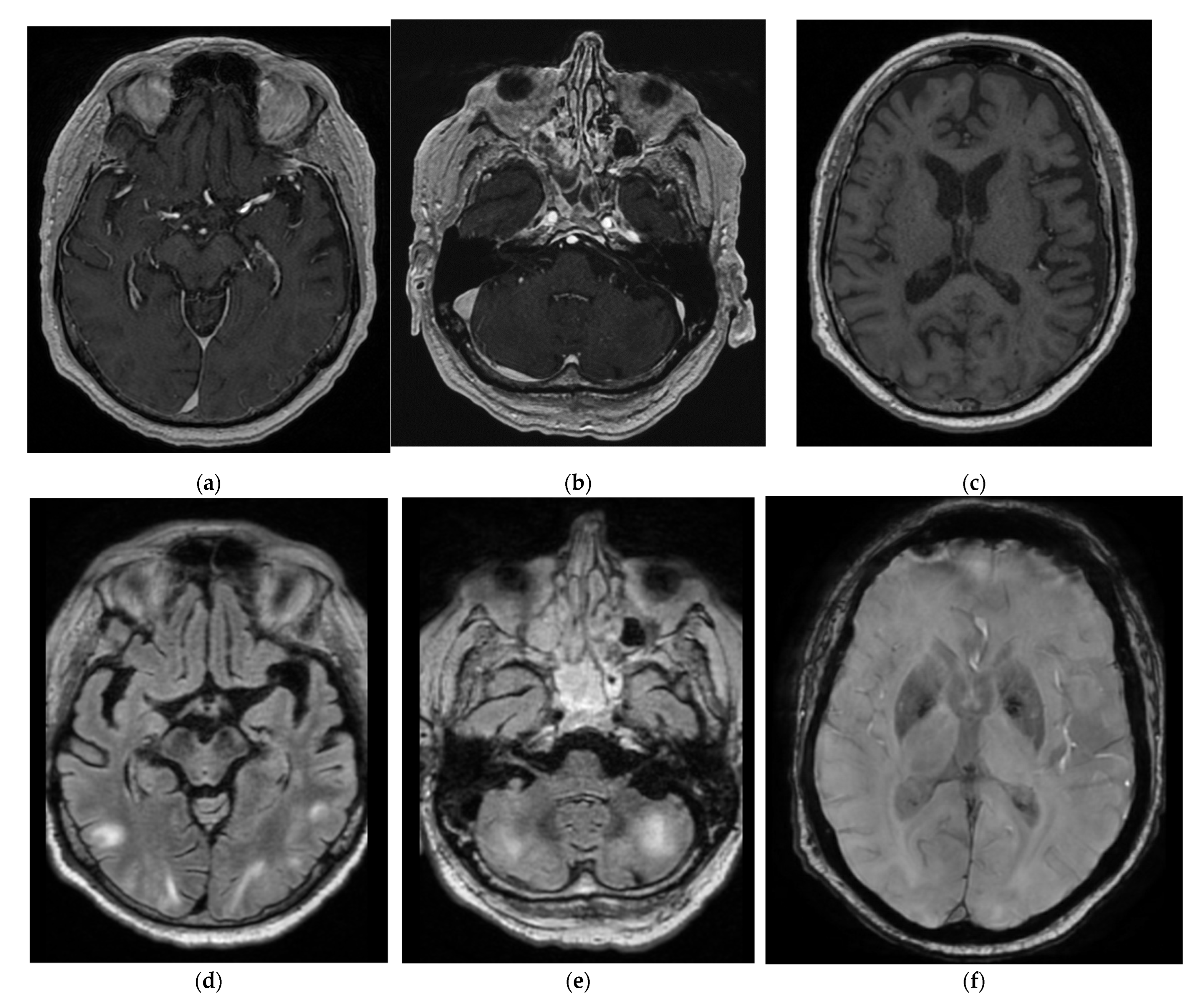 Zyrtec-D - Risks of posterior reversible encephalopathy syndrome