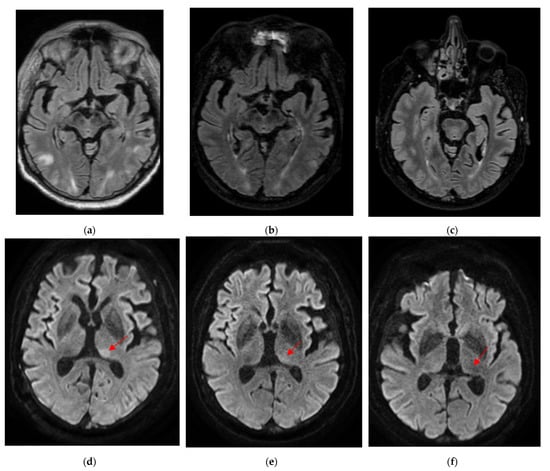 Zyrtec-D - Risks of posterior reversible encephalopathy syndrome