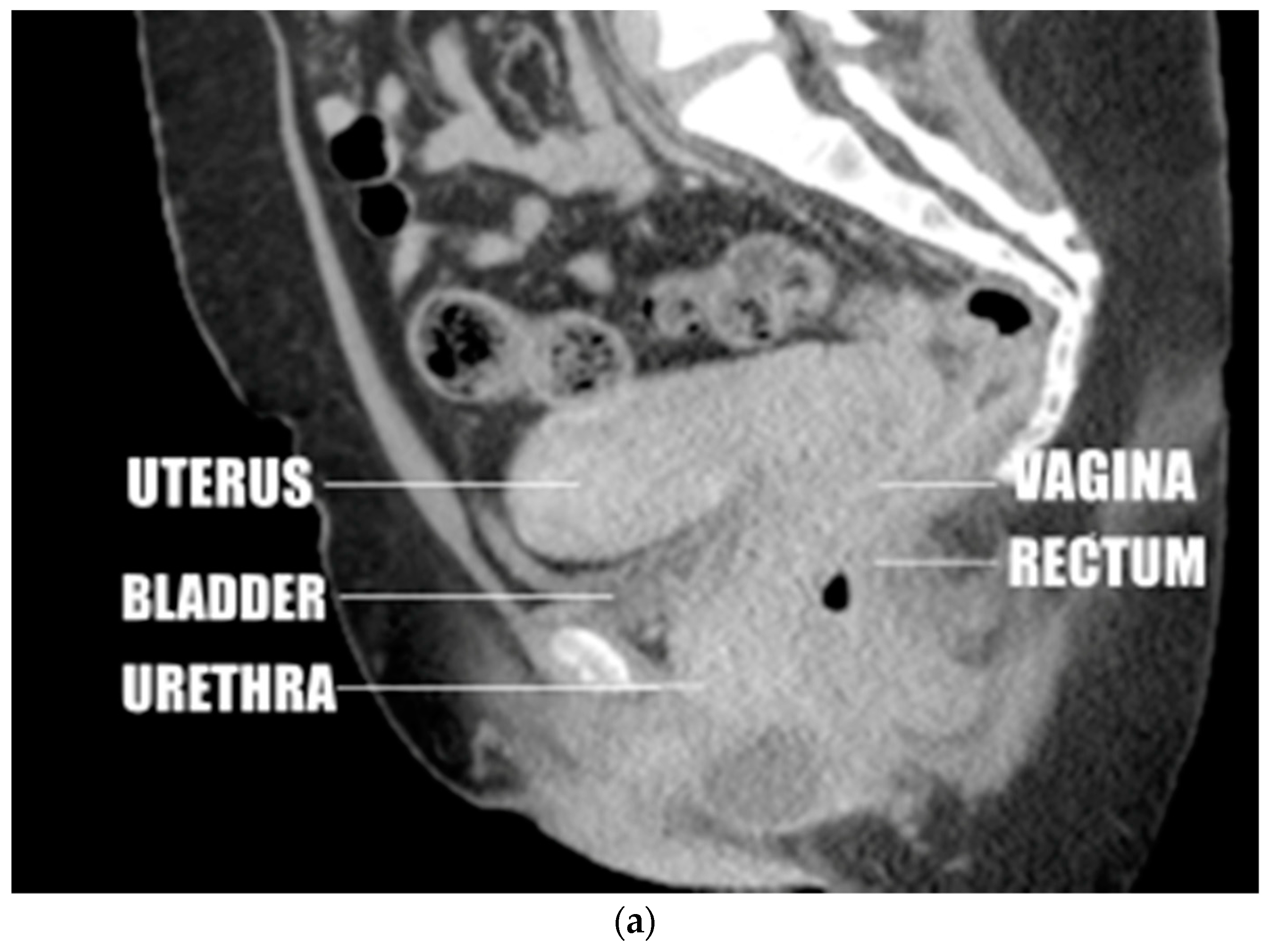 retroflexed uterus mri