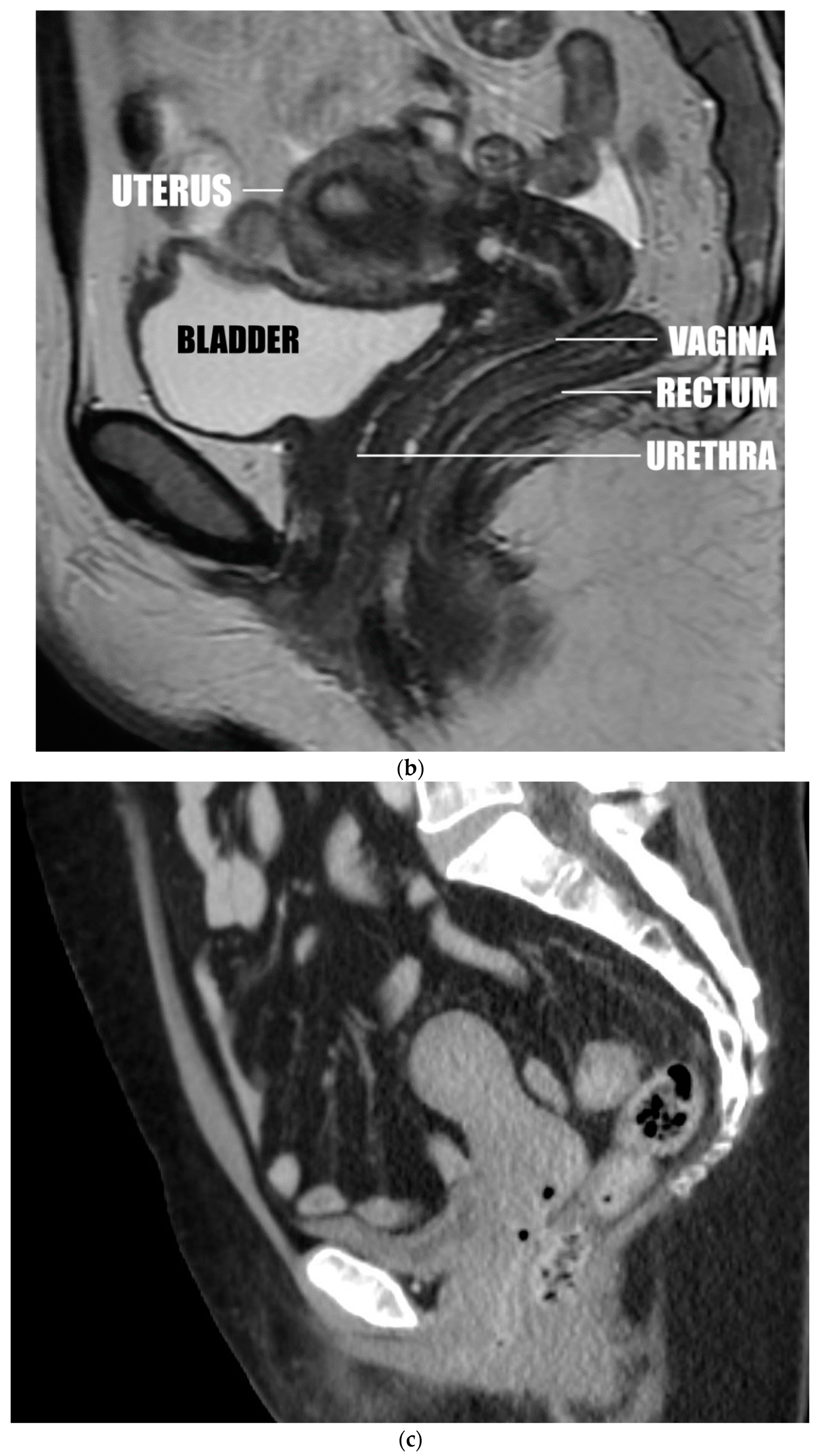 Bladder prolapse into vagina, Radiology Case