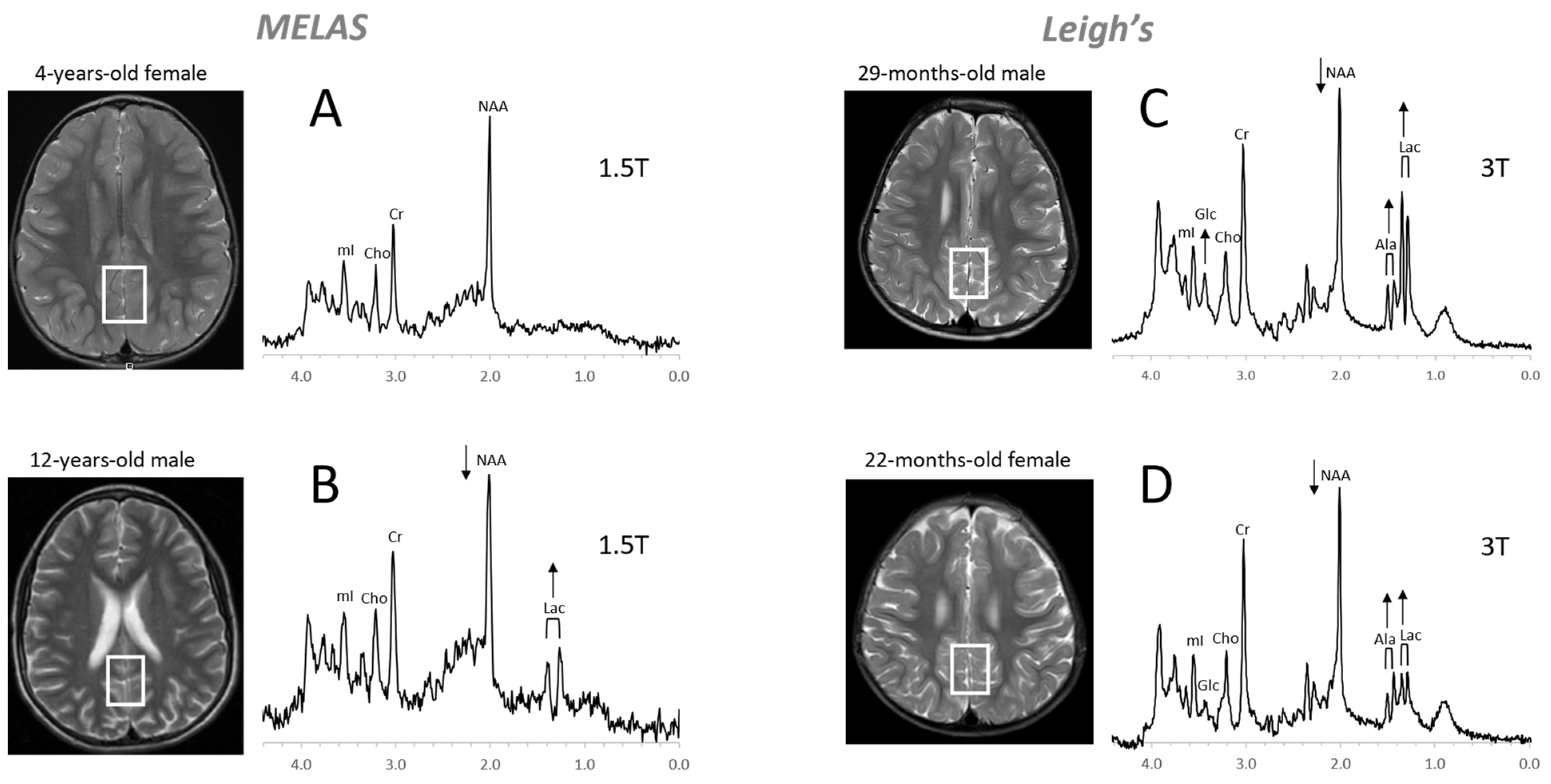 Diagnostics | Free Full-Text | Proton MR Spectroscopy of Pediatric Brain  Disorders