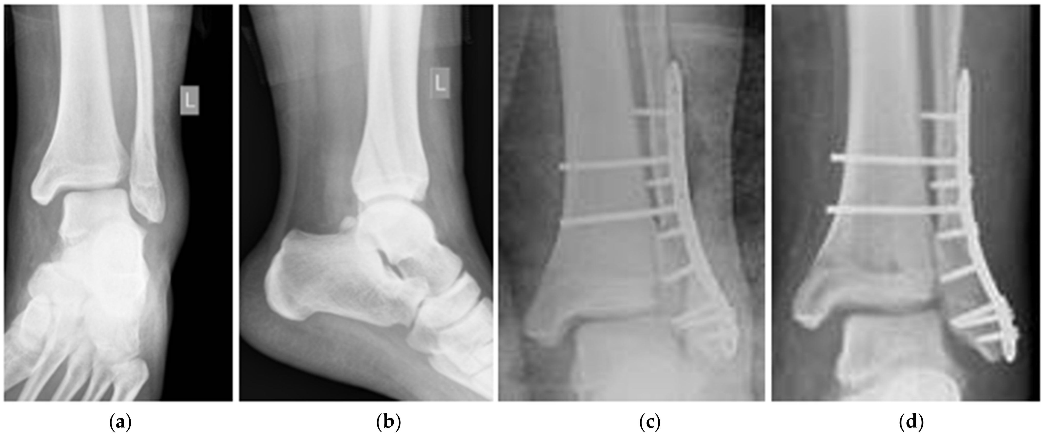 Diagnostics | Free Full-Text | Deformation of the Titanium Plate  Stabilizing the Lateral Ankle Fracture Due to Its Overloading in Case of  the Young, Obese Patient: Case Report Including the Biomechanical Analysis