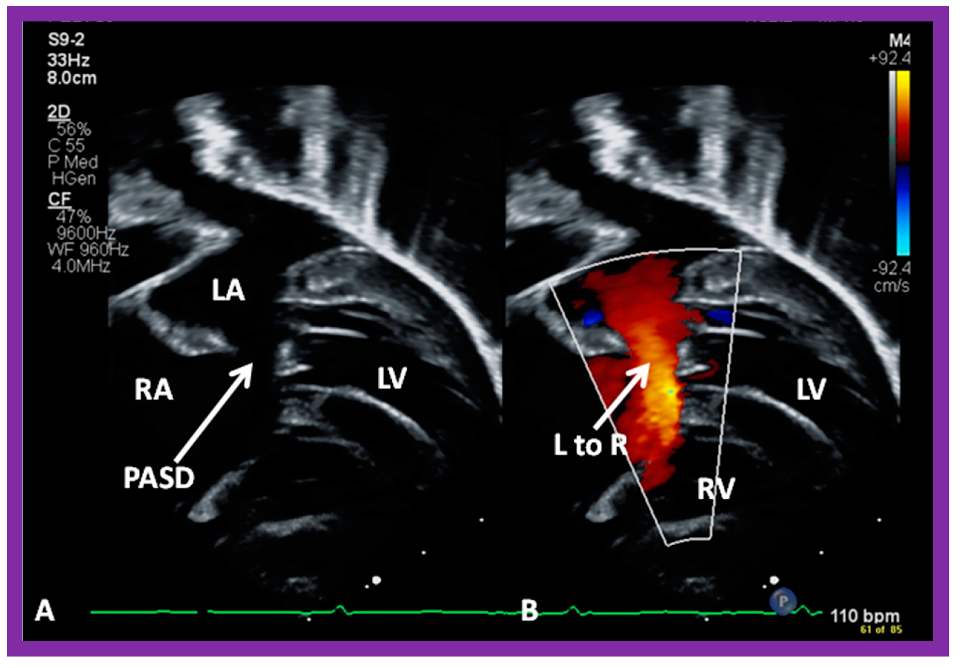 Diagnostics | Free Full-Text | Role of Echocardiography in the Diagnosis  and Interventional Management of Atrial Septal Defects
