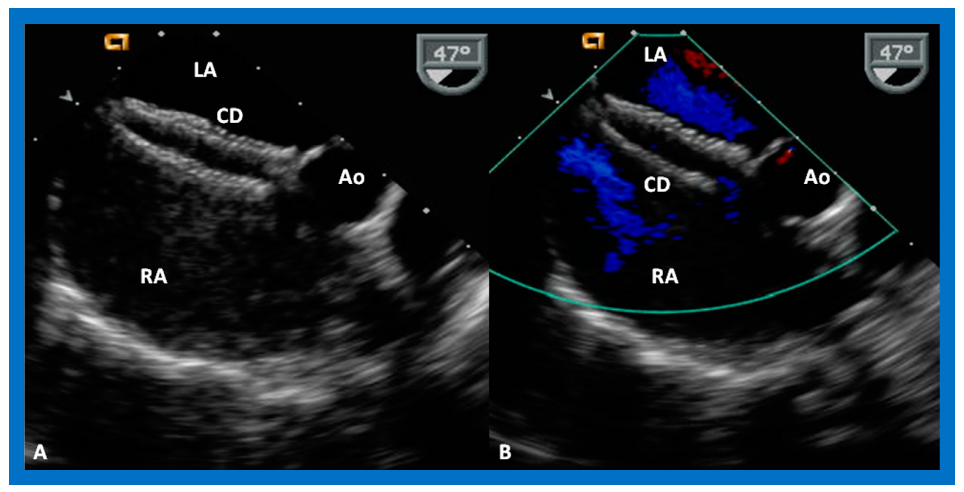 Diagnostics | Free Full-Text | Role of Echocardiography in the Diagnosis  and Interventional Management of Atrial Septal Defects | HTML