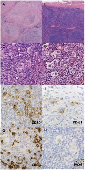 Diagnostics | Free Full-Text | Hodgkin Lymphoma: Biology and