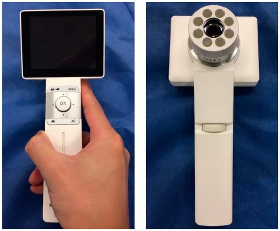 Diagnostics | Free Full-Text | Photodynamic Diagnosis Using  5-Aminolevulinic Acid with a Novel Compact System and Chromaticity Analysis  for the Detection of Oral Cancer and High-Risk Potentially Malignant Oral  Disorders