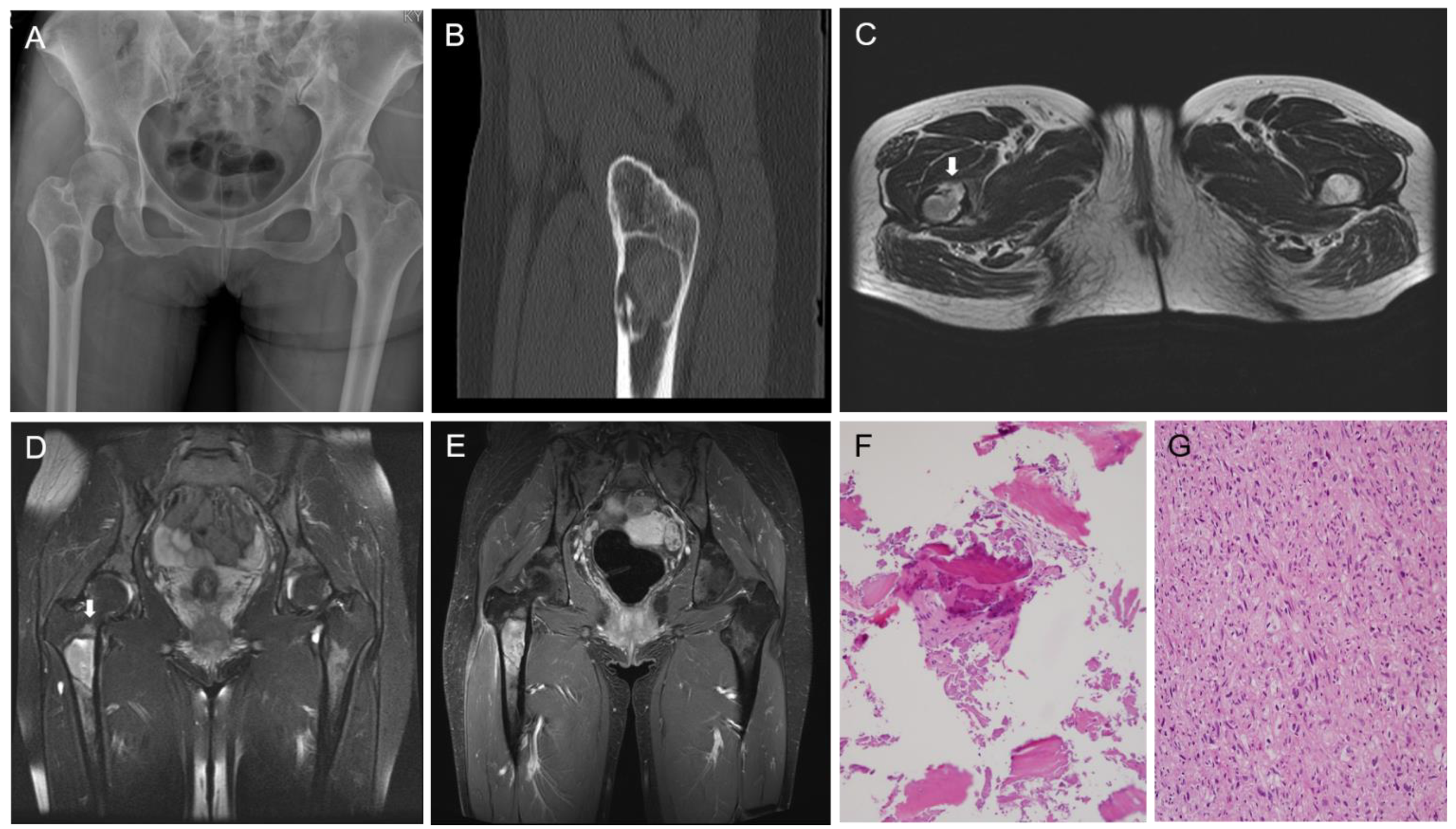polyostotic fibrous dysplasia of bone