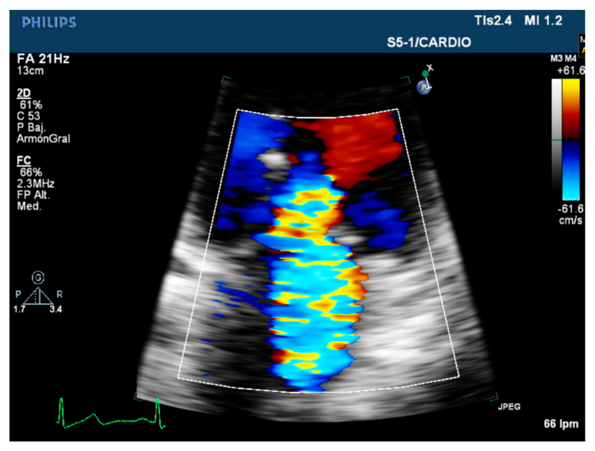 Diagnostics | Free Full-Text | Practical Echocardiographic Approach of the  Regurgitant Mitral Valve Assessment