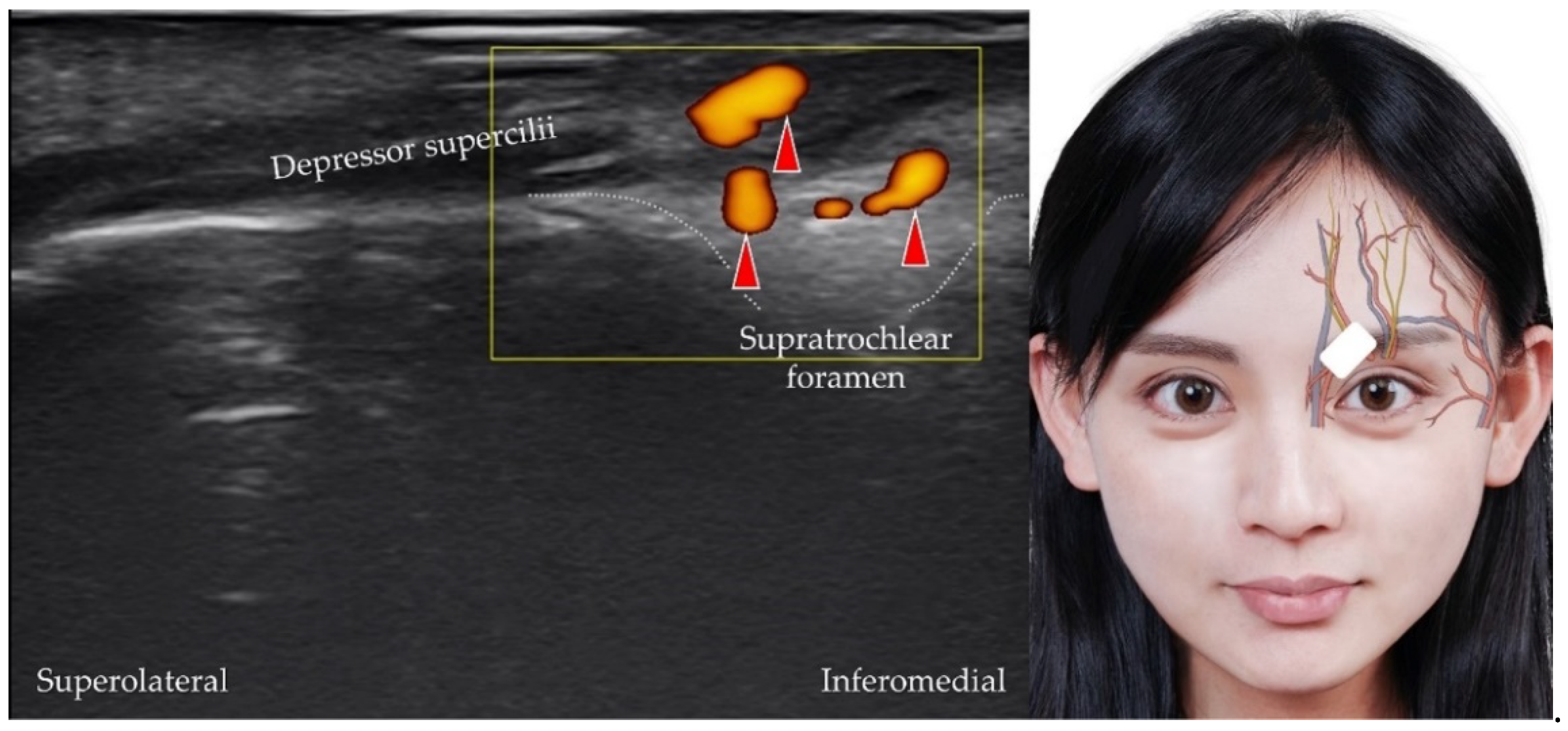 Diagnostics Free Full Text Ultrasound Imaging Of Facial Vascular Neural Structures And 1004