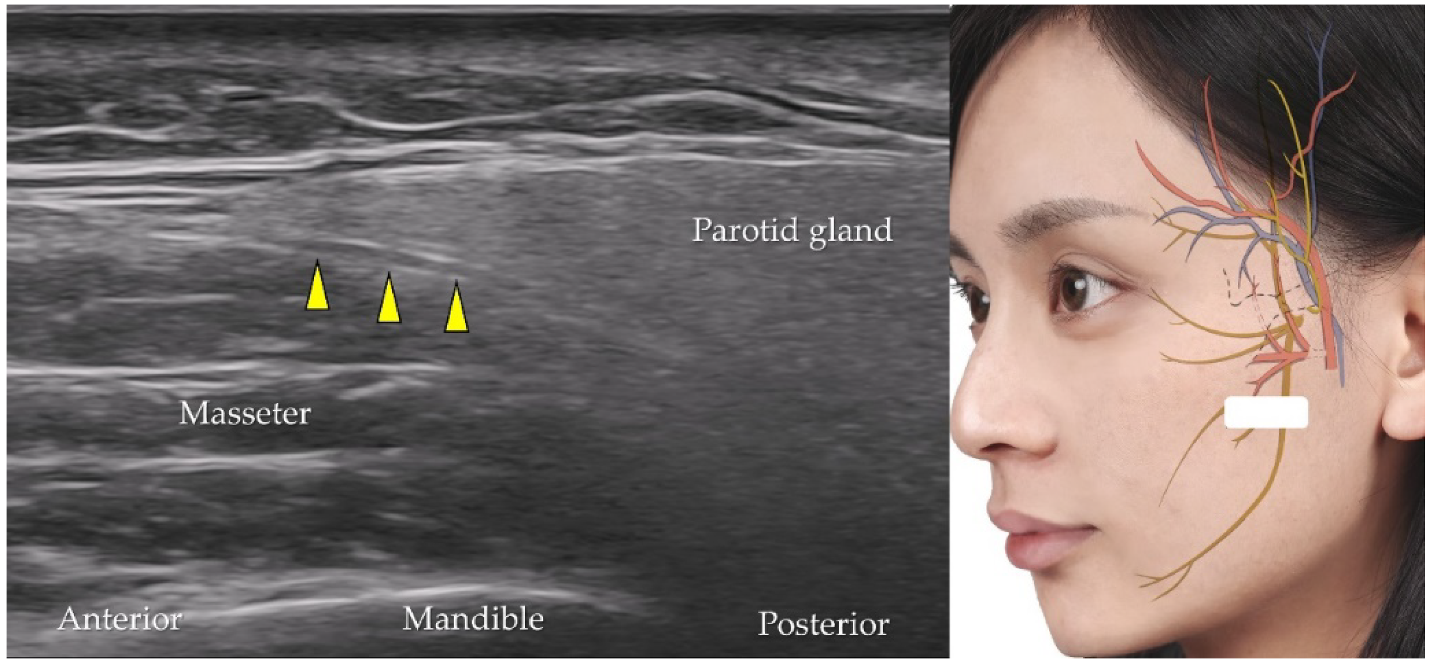 Diagnostics Free Full Text Ultrasound Imaging Of Facial Vascular Neural Structures And 6438