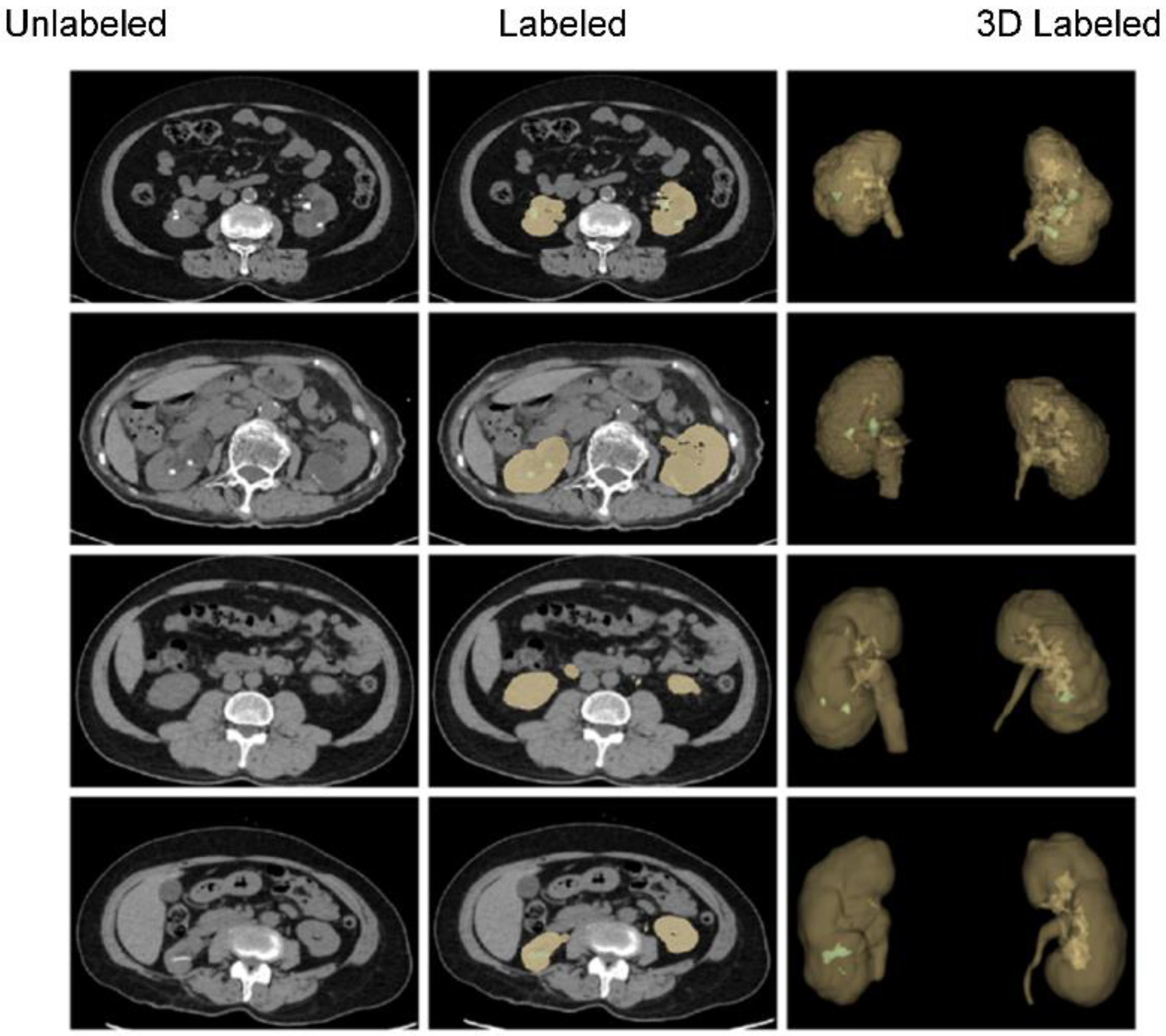 Diagnostics | Free Full-Text | Deep Segmentation Networks for Segmenting  Kidneys and Detecting Kidney Stones in Unenhanced Abdominal CT Images