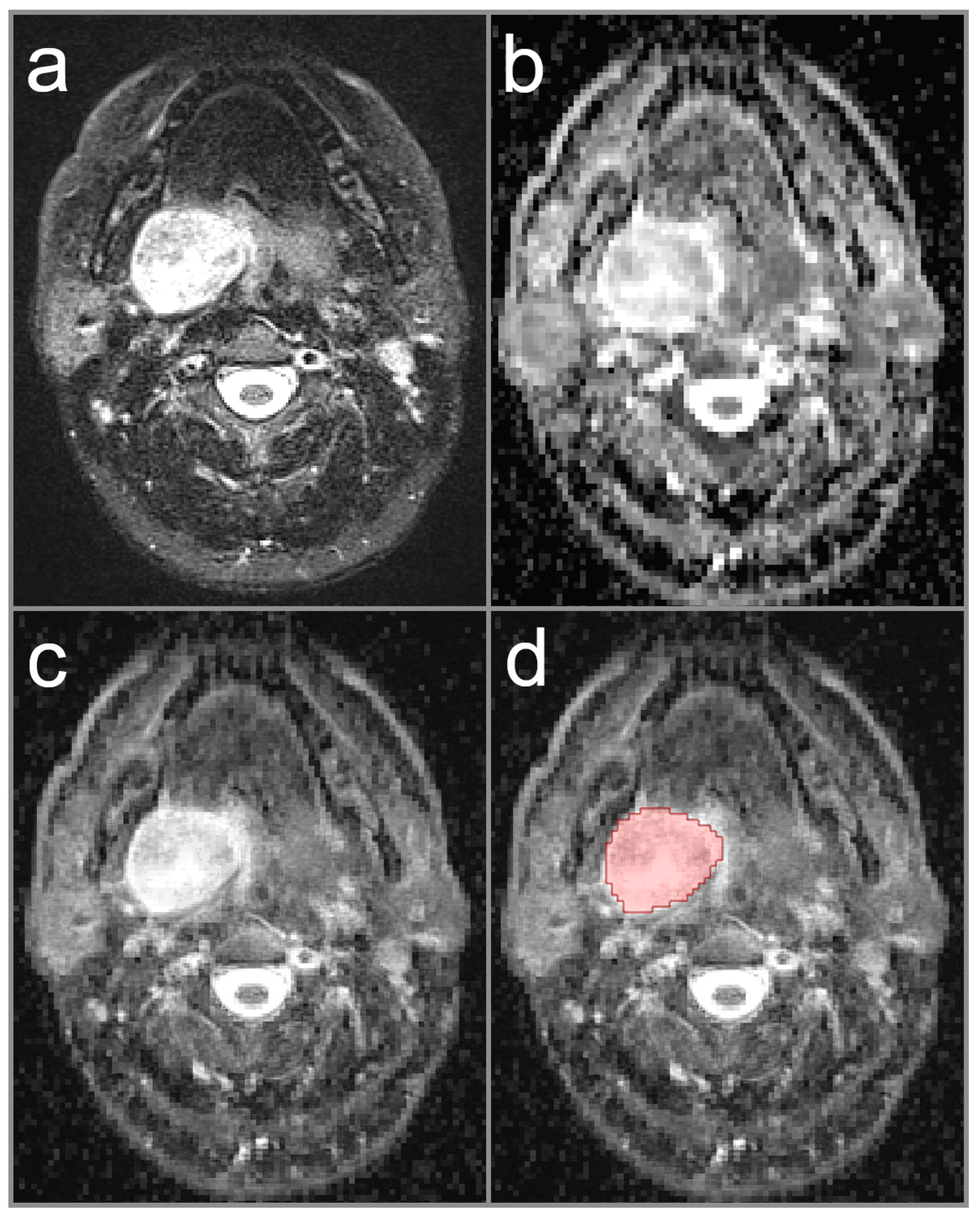Diagnostics | Free Full-Text | Apparent Diffusion Coefficient (ADC)  Histogram Analysis in Parotid Gland Tumors: Evaluating a Novel Approach for  Differentiation between Benign and Malignant Parotid Lesions Based on Full  Histogram Distributions