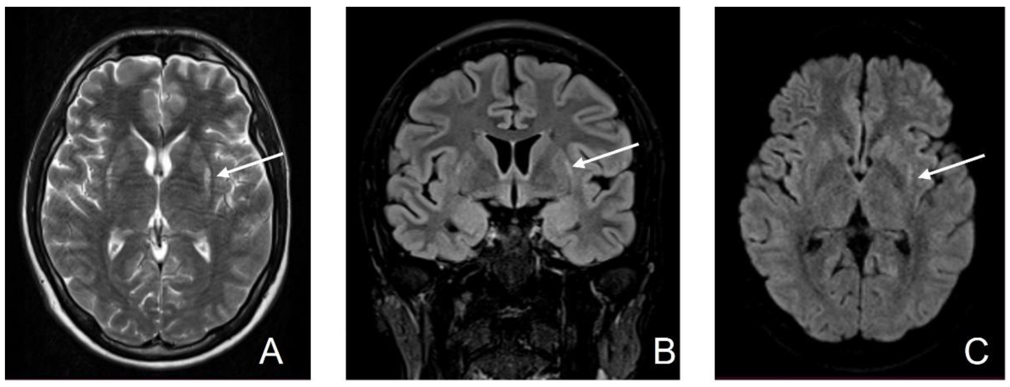 Diagnostics | Free Full-Text | MRI Evolution of a Patient with Viral ...