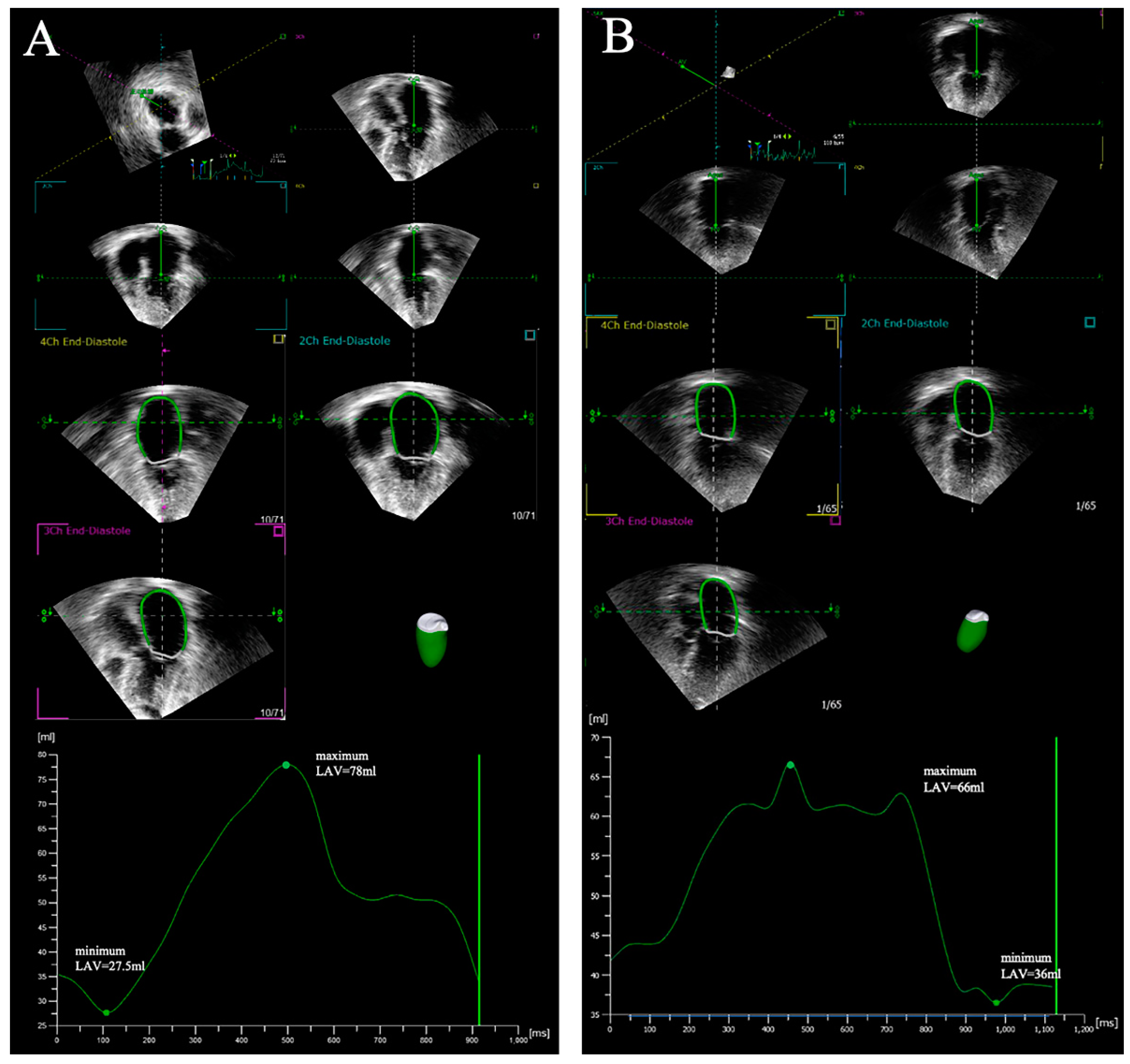 Diagnostics | Free Full-Text | Assessment of Left Atrial Structure and  Function by Echocardiography in Atrial Fibrillation