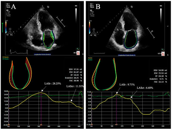 Association Between Global Longitudinal Strain and Cardiovascular Events in  Patients With Left Bundle Branch Block Assessed Using Two-Dimensional  Speckle-Tracking Echocardiography