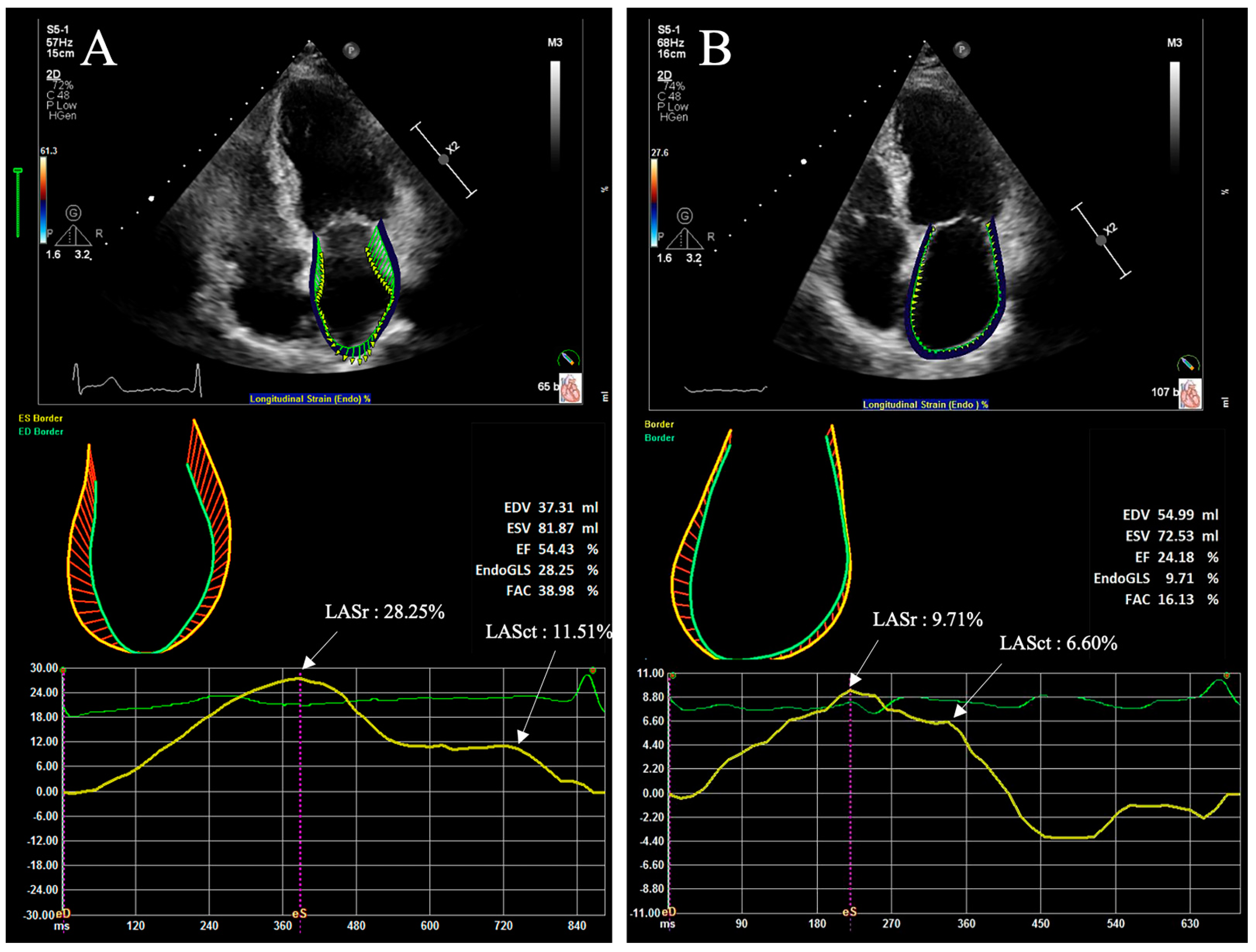 Left ventricular strain assessed by 2-dimensional speckle tracking
