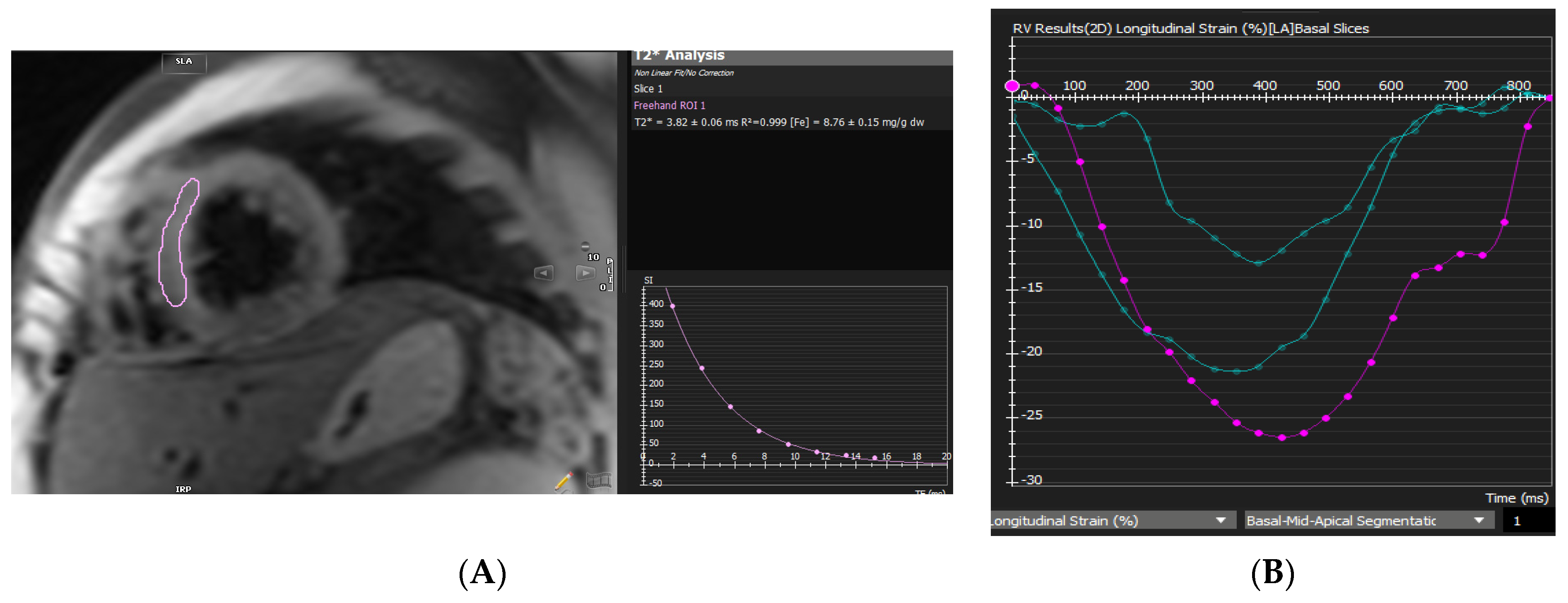 Feature Tracking of Global Longitudinal Strain by Using Cardiovascular MRI  Improves Risk Stratification in Heart Failure with Preserved Ejection  Fraction