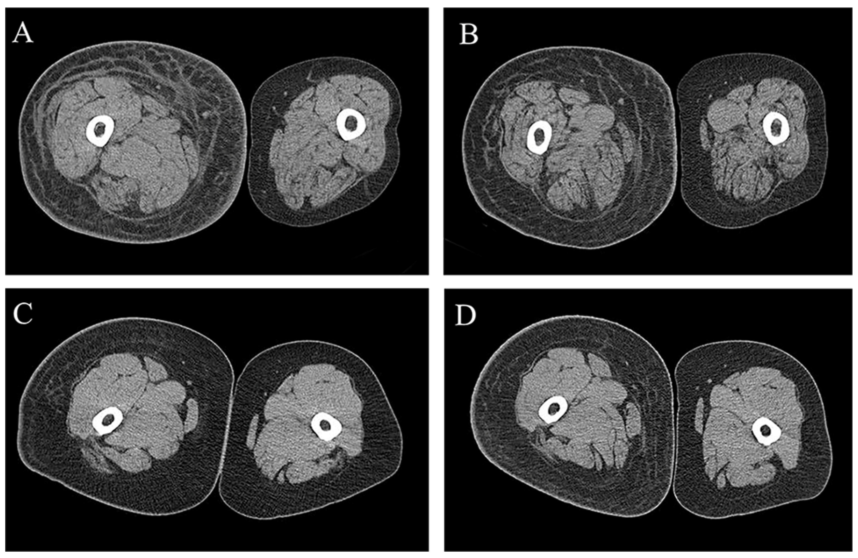 Recovering Cancer Patient Showing Subcutaneous Chemotherapy