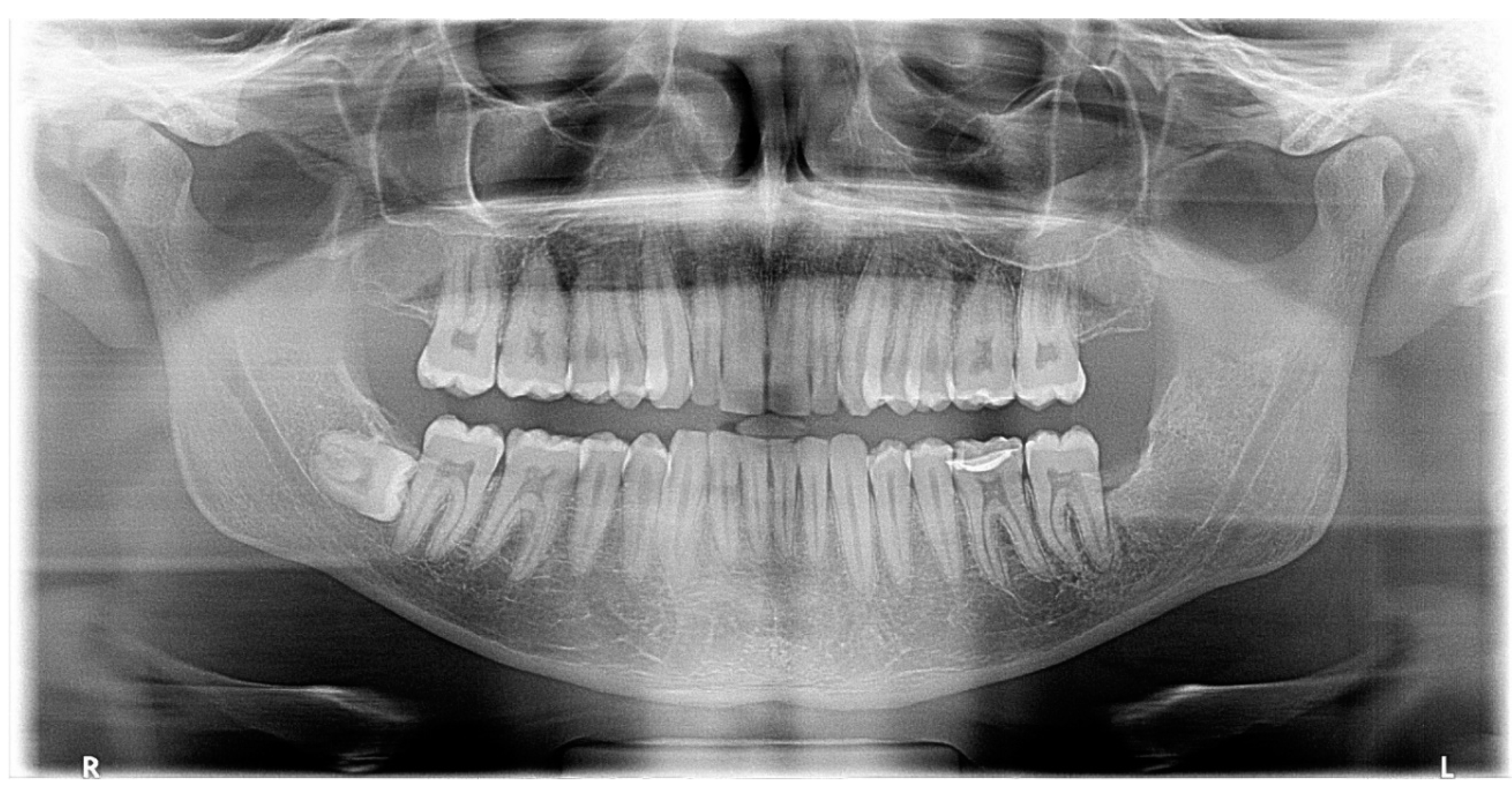 Diagnostics Free Full Text Dentigerous Cysts With Diverse Radiological Presentation