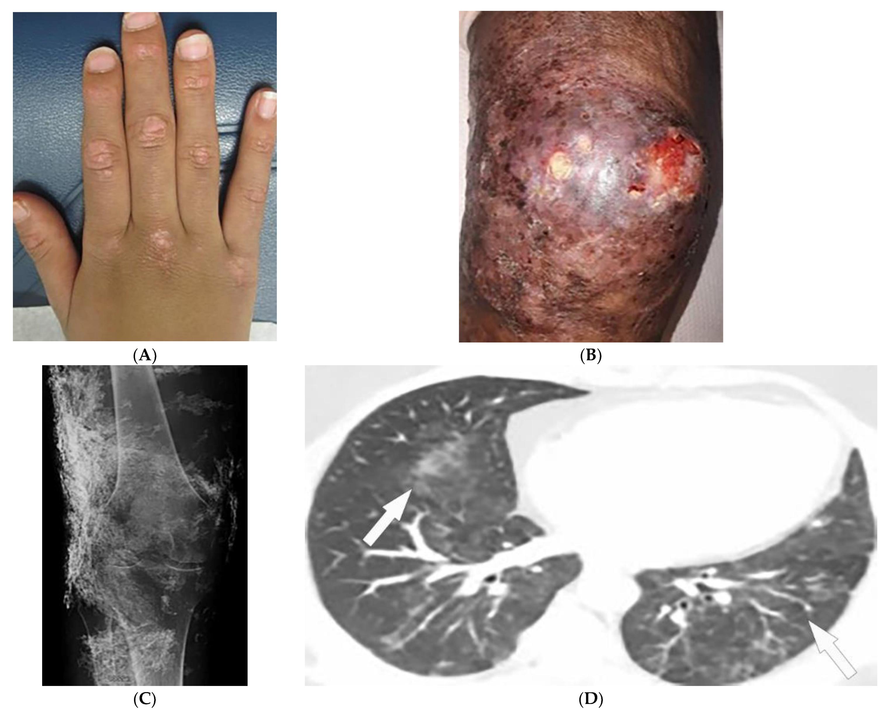 Diagnostics | Free Full-Text | Imaging More than Skin-Deep: Radiologic and  Dermatologic Presentations of Systemic Disorders