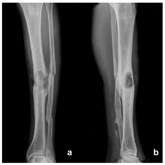 Diagnostics | Free Full-Text | Management of Squamous Cell Carcinoma in  Chronic Osteomyelitis: Our Experience, Review of the Literature and Role of  MRI in Differential Diagnosis
