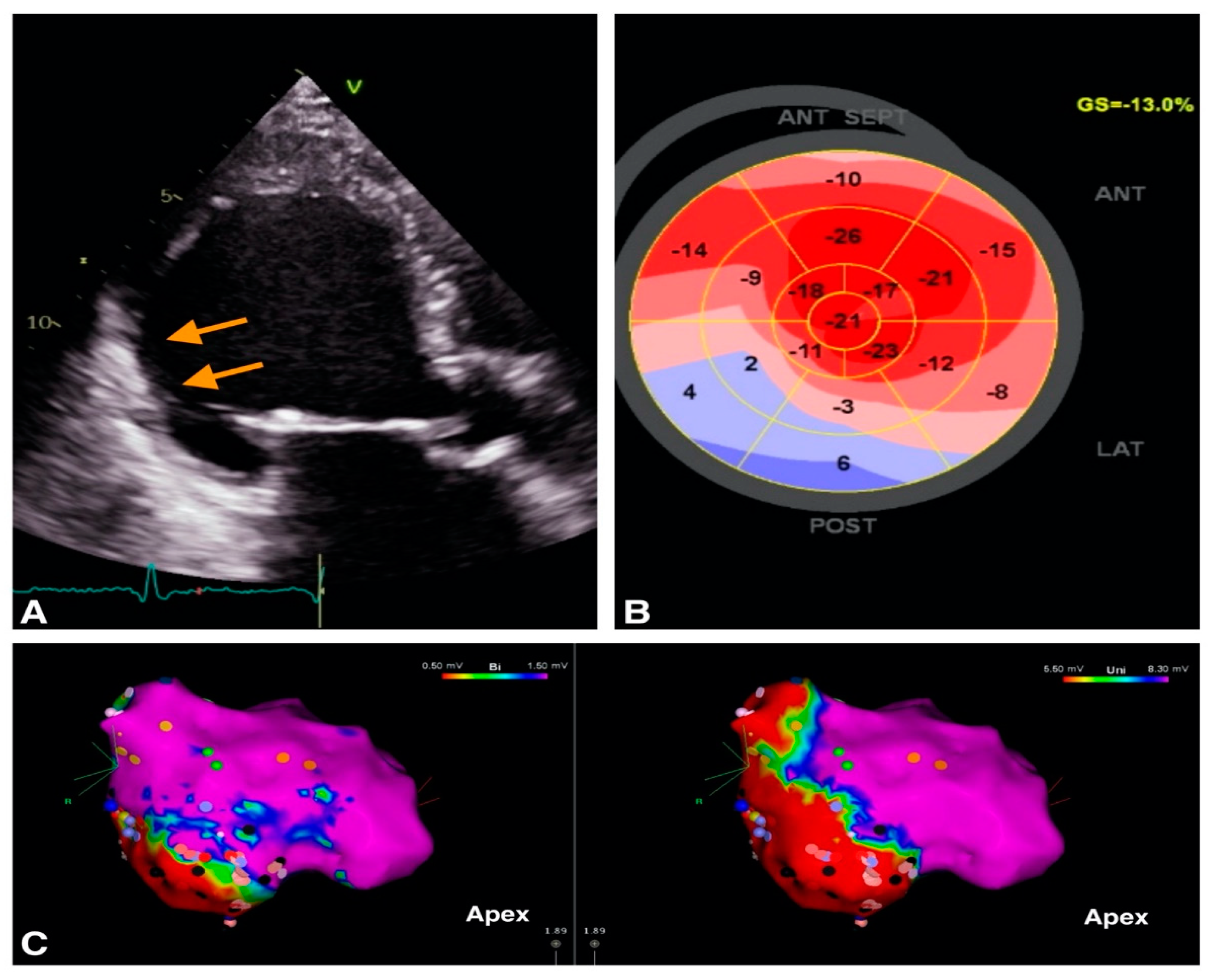 Diagnostics | Free Full-Text | Behind Enemy Lines: Vital Echocardiographic  Data Prior to Ventricular Arrhythmia Ablation