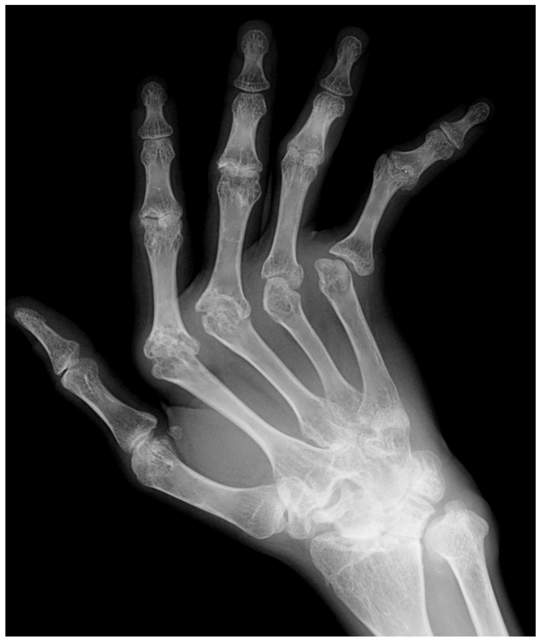 osteoarthritis hand xray