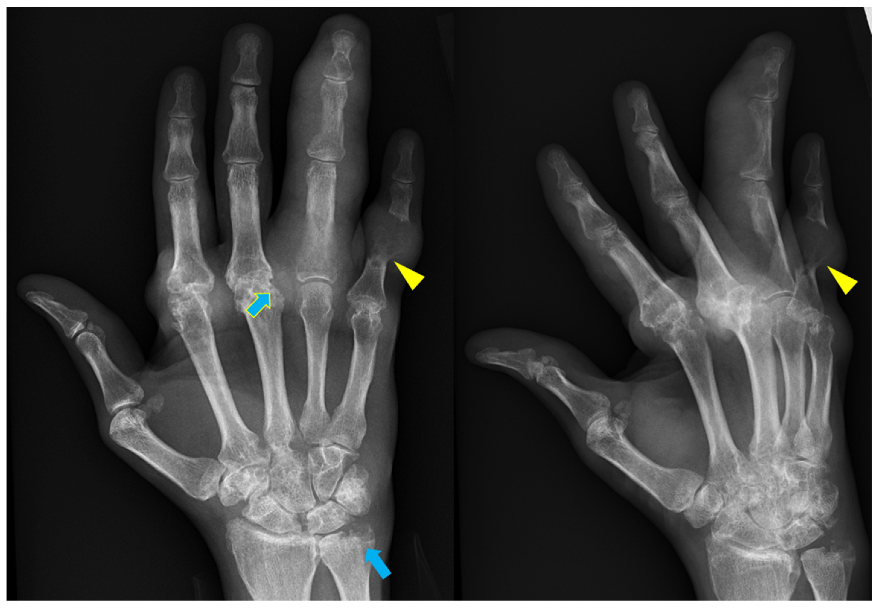 arthritis on hand x ray        <h3 class=