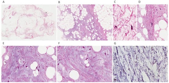 Diagnostics | Free Full-Text | Giant Paratesticular Liposarcoma ...