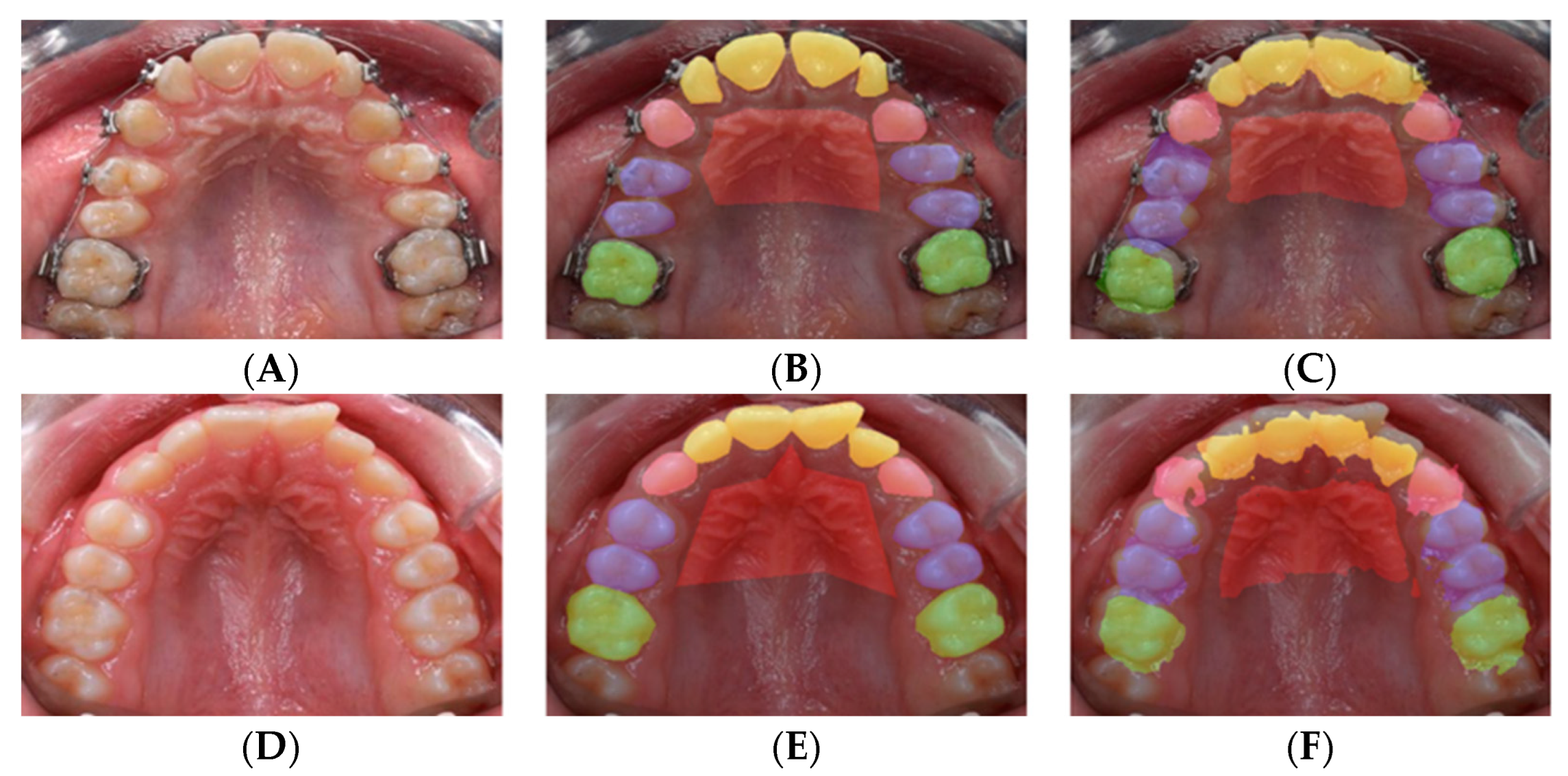 What are teeth craze lines? by PavaniJagat - Issuu