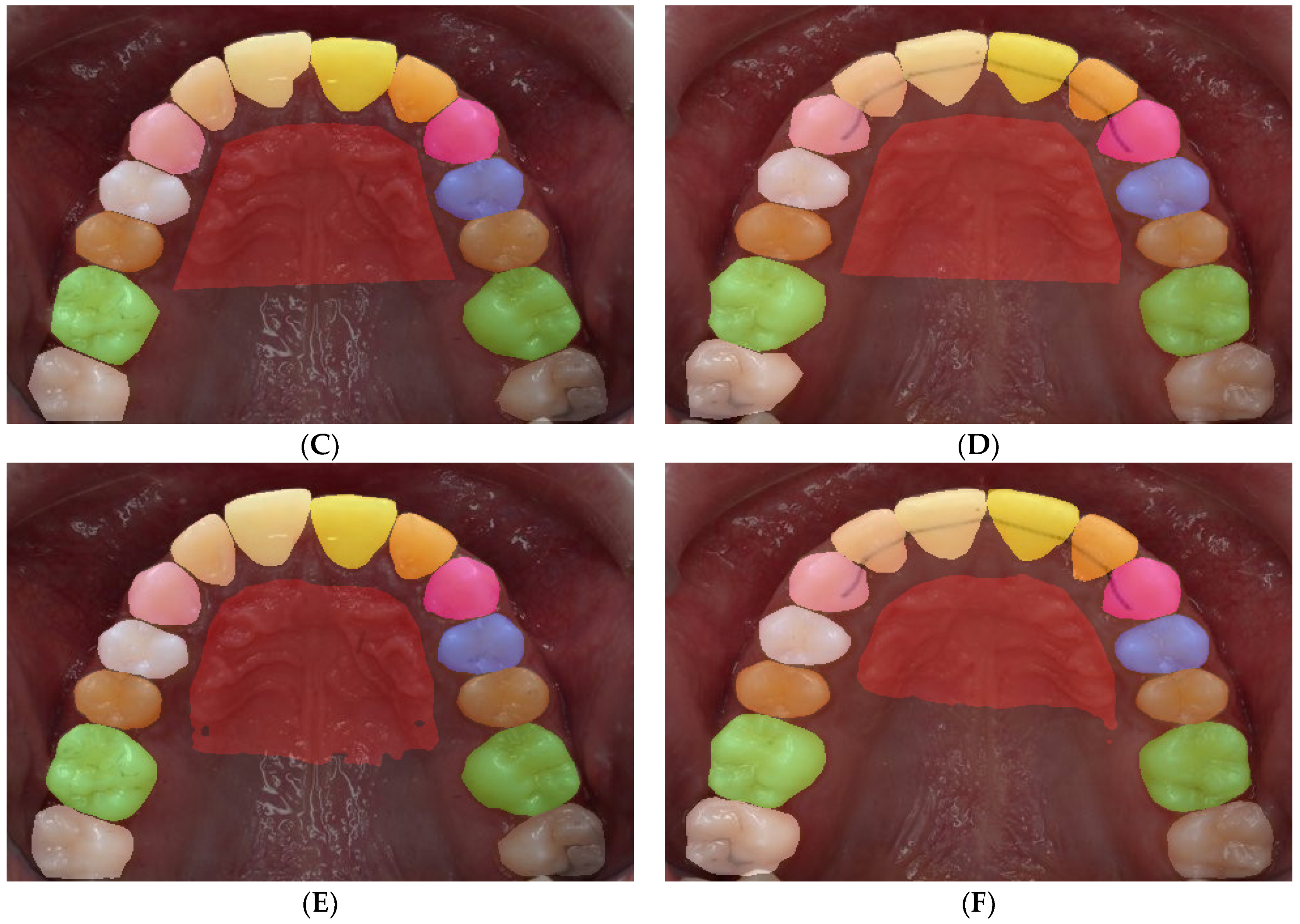 What are teeth craze lines? by PavaniJagat - Issuu