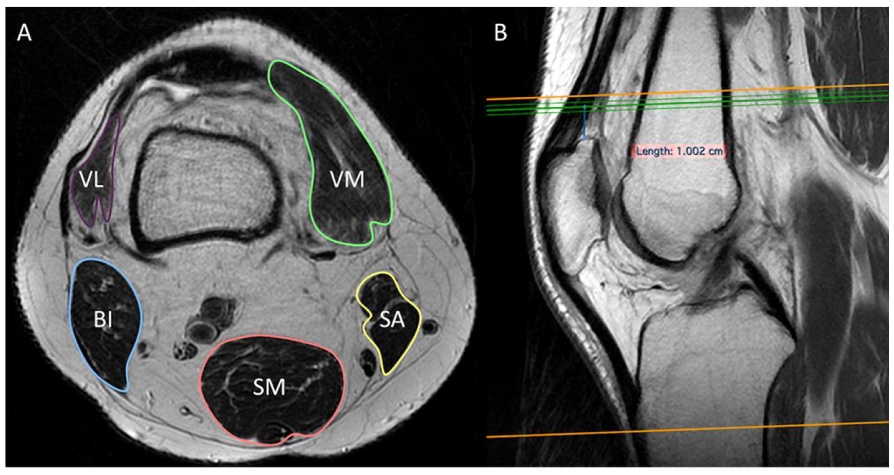 Thigh burn – A magnetic resonance imaging (MRI) related adverse