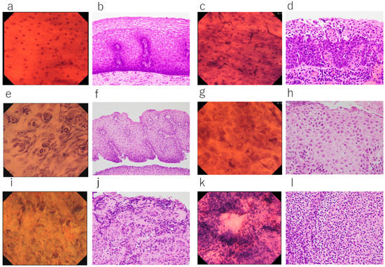 Diagnostics | Free Full-Text | Endocytoscopic Observation of Esophageal ...