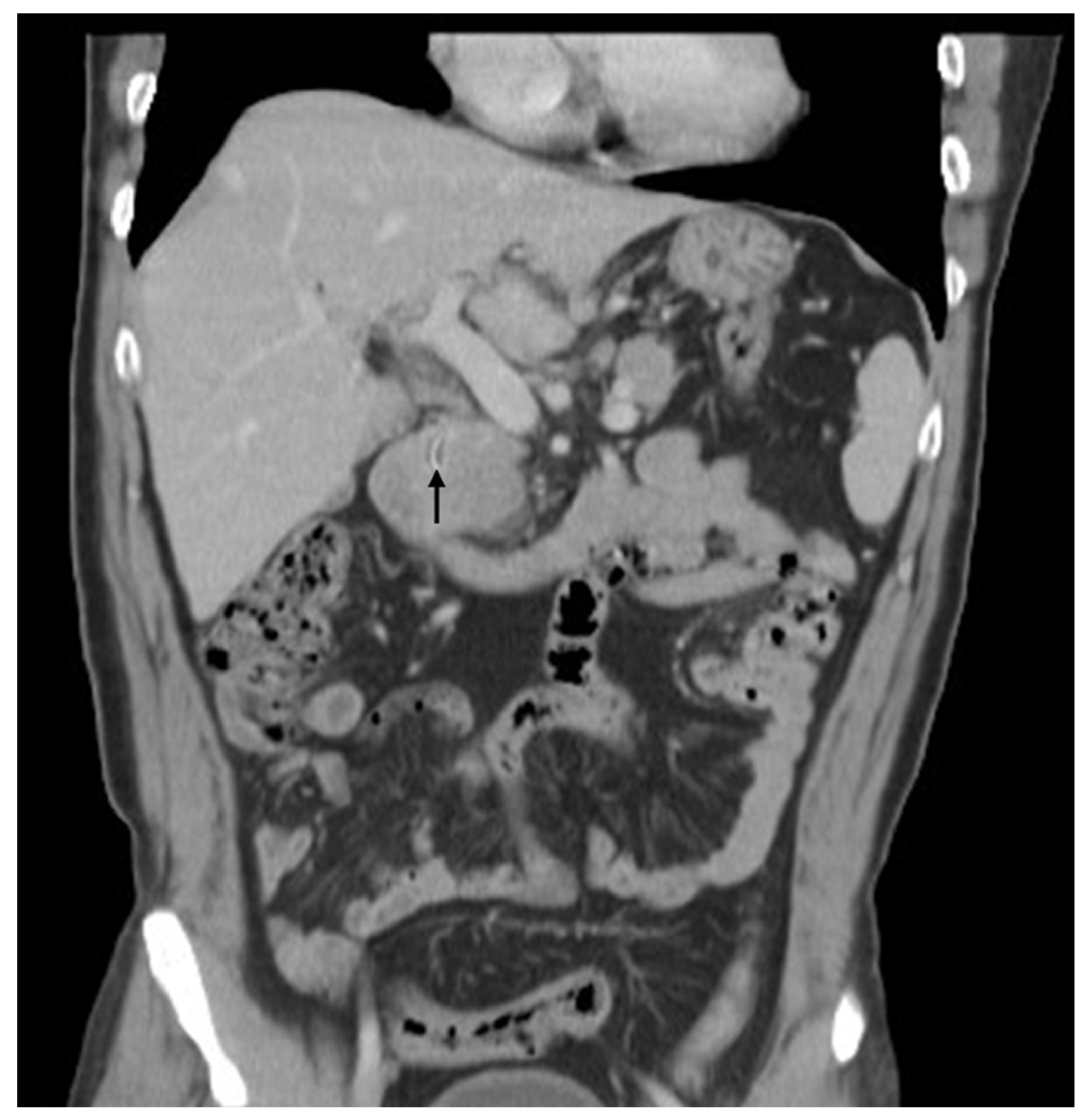 Diagnostics Free Full Text Migration Of A Retained Surgical Suture