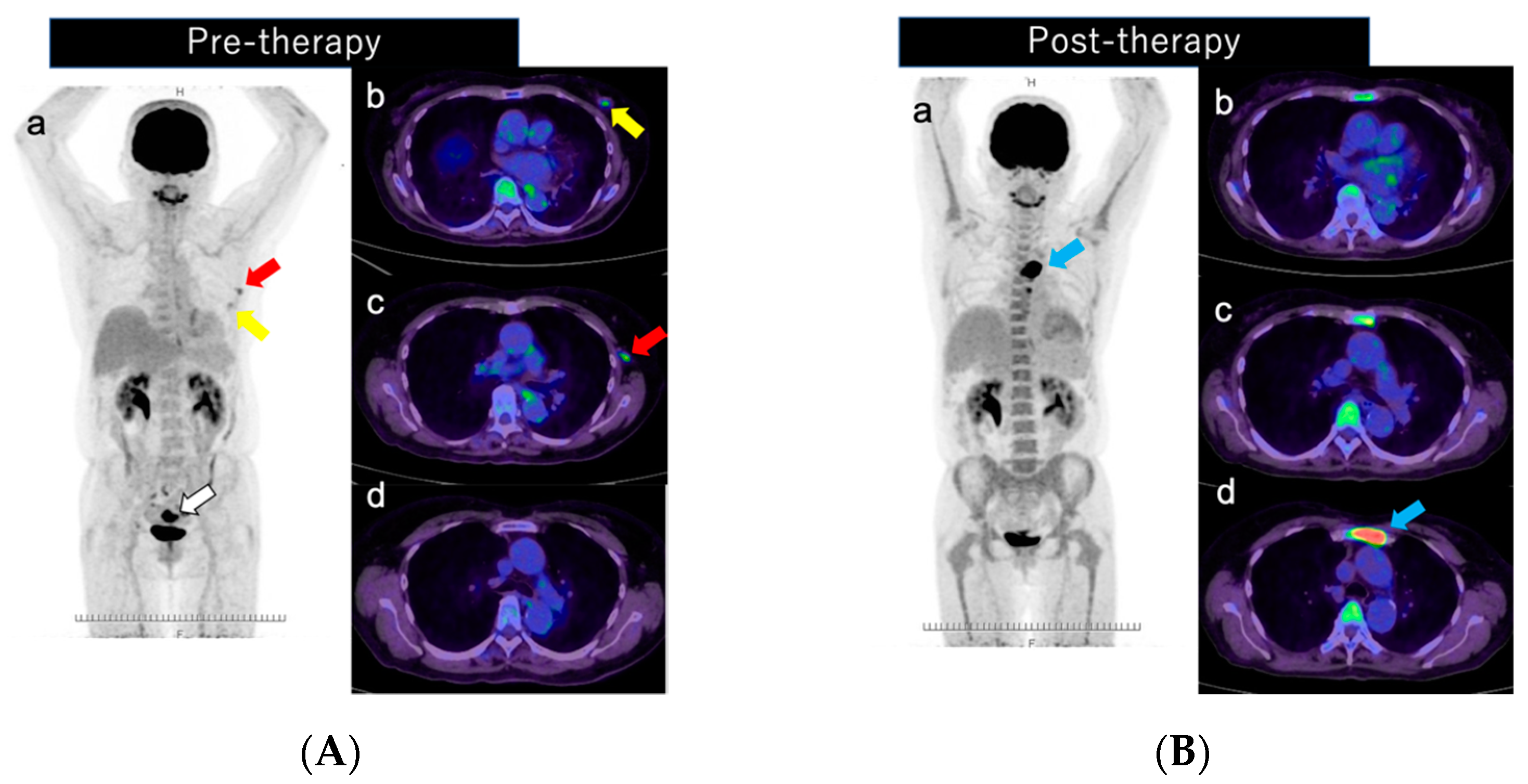 Diagnostics | Free Full-Text | Focal Uptake In The Sternum On 18F-FDG ...