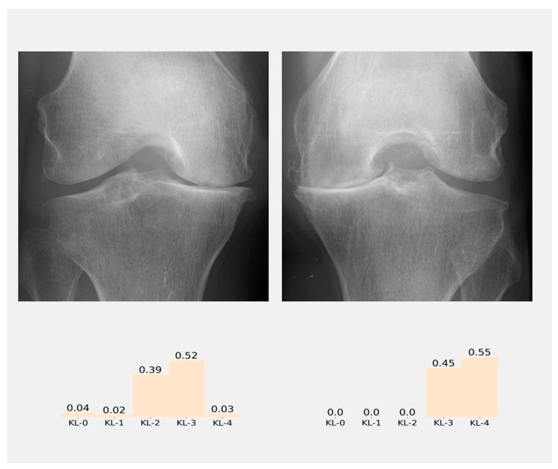 Diagnostics Free Full Text Detection And Classification Of Knee Osteoarthritis