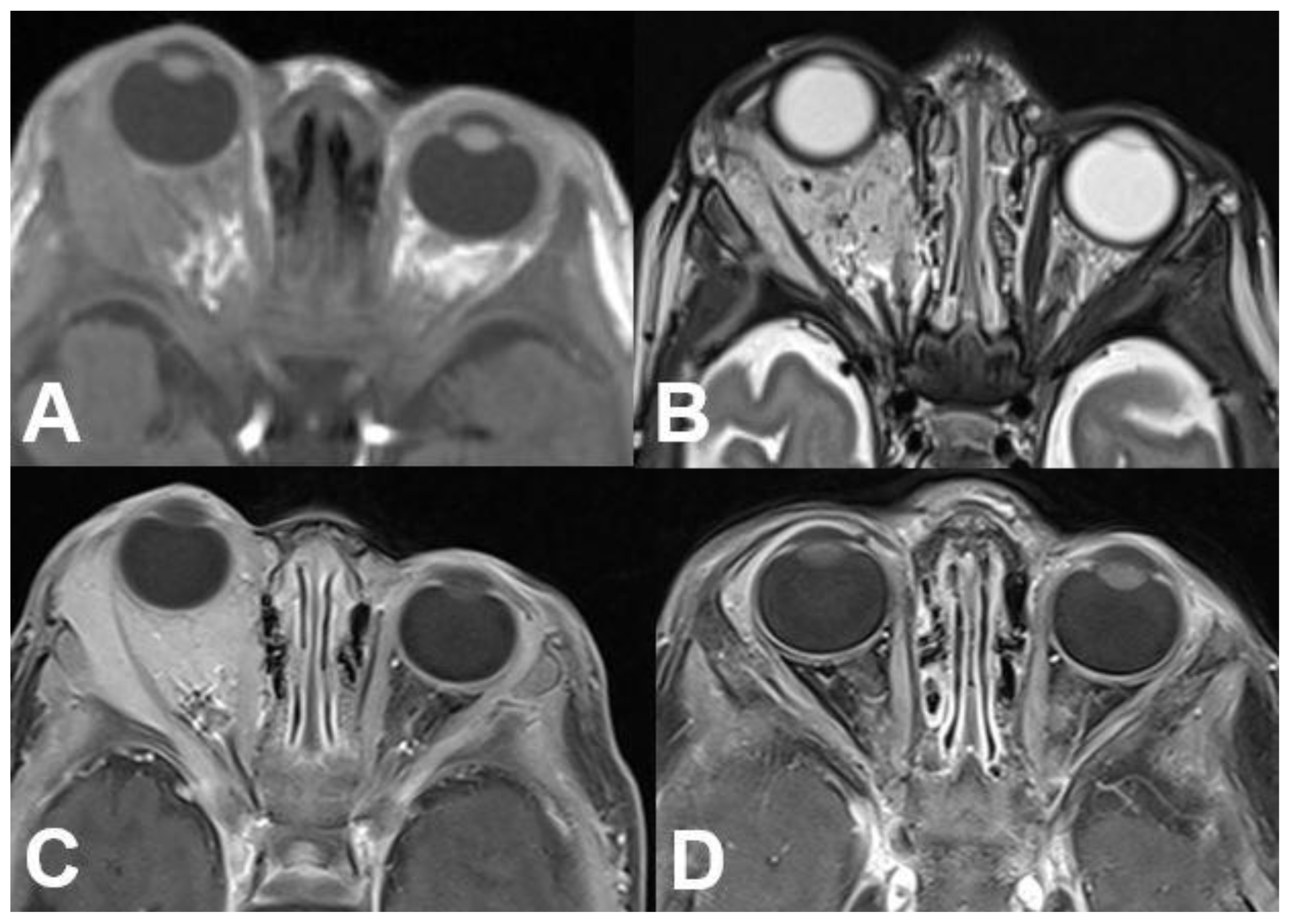 Diagnostics Free Full Text Orbital Tumors—clinical Radiologic And