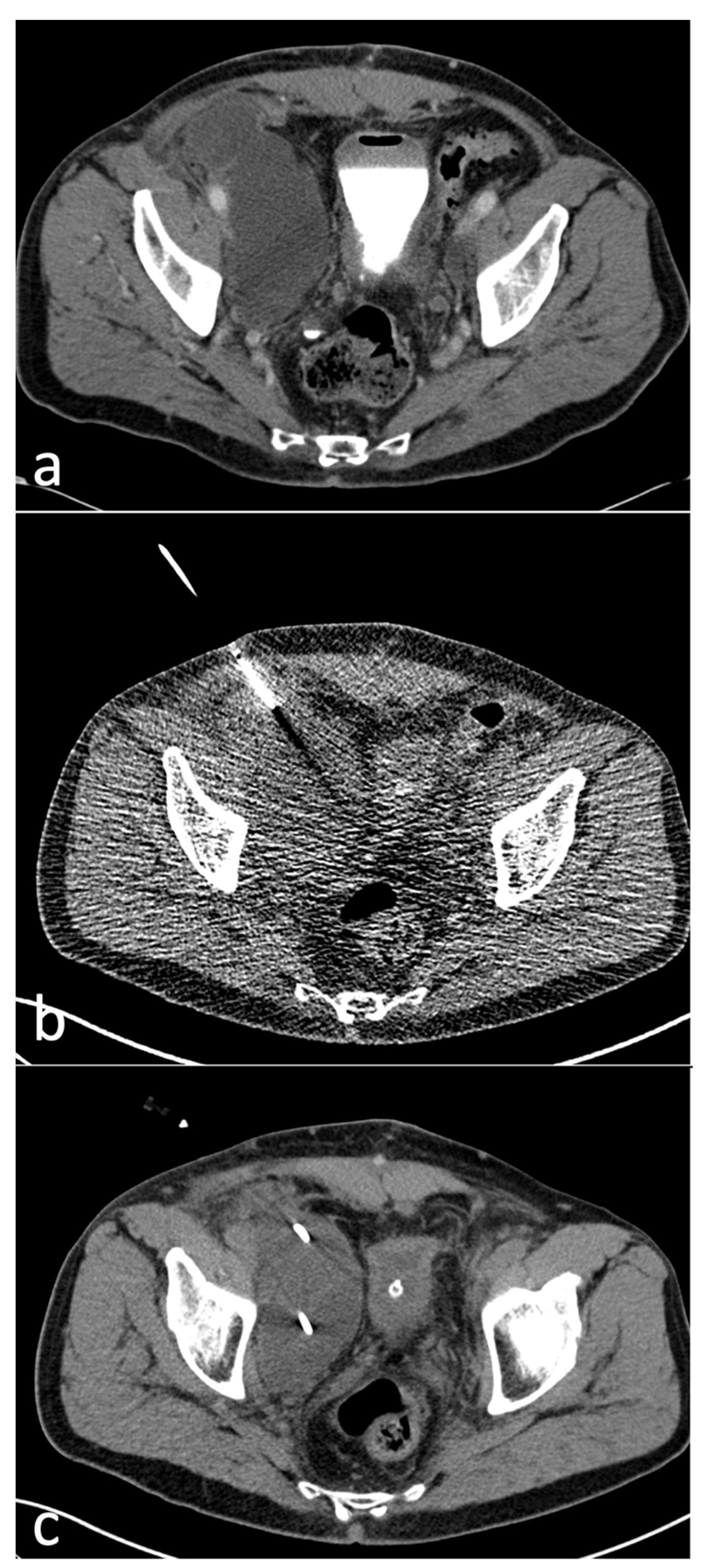 Diagnostics Free Full Text Technical Outcome Clinical Success And Complications Of Low Milliampere Computed Tomography Fluoroscopy Guided Drainage Of Lymphoceles Following Radical Prostatectomy With Pelvic Lymph Node Dissection