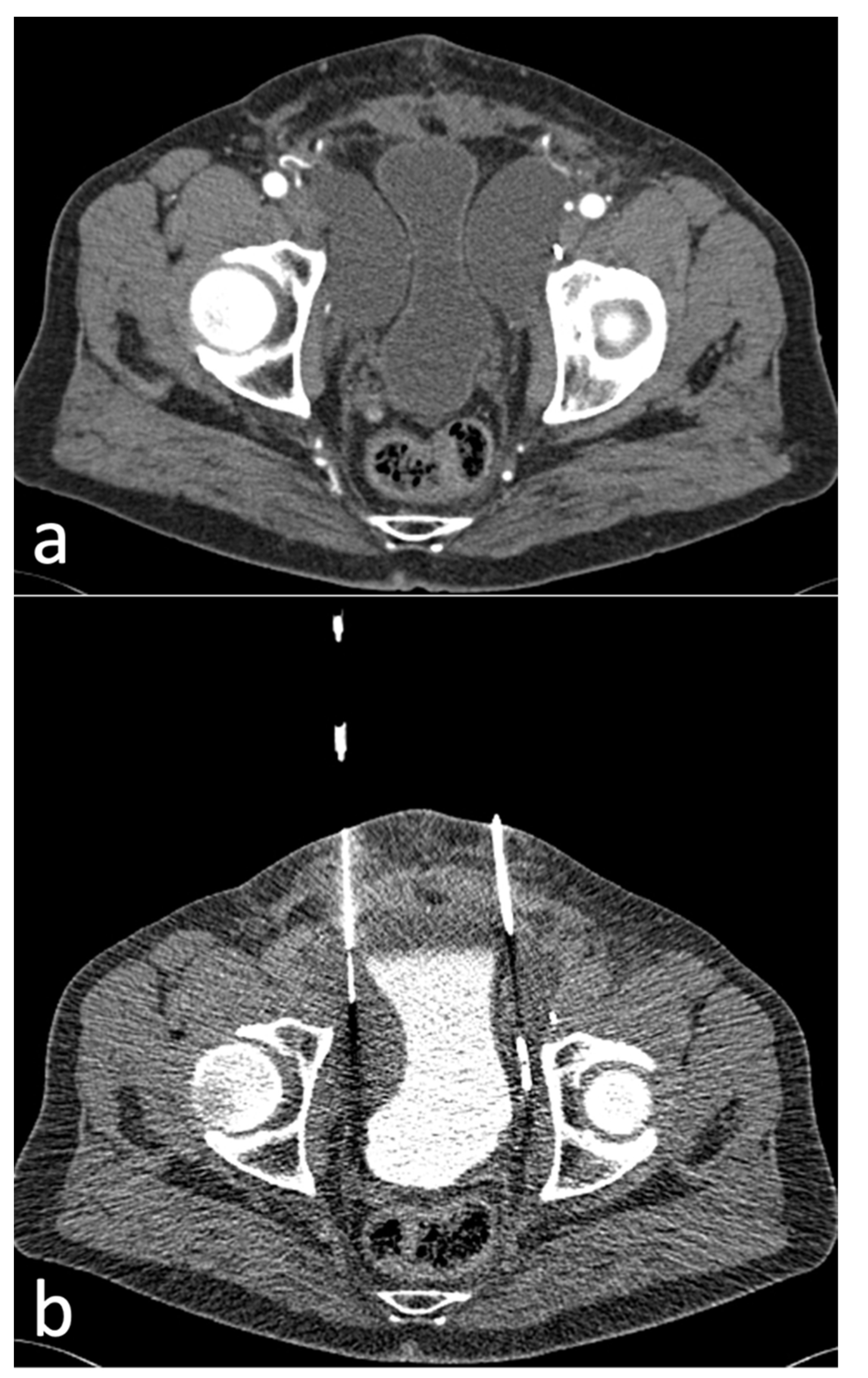 Diagnostics Free Full Text Technical Outcome Clinical Success And Complications Of Low Milliampere Computed Tomography Fluoroscopy Guided Drainage Of Lymphoceles Following Radical Prostatectomy With Pelvic Lymph Node Dissection