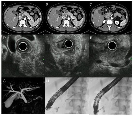 Diagnostics Free Full Text Utility Of Endoscopic Ultrasound Guided Fine Needle Aspiration