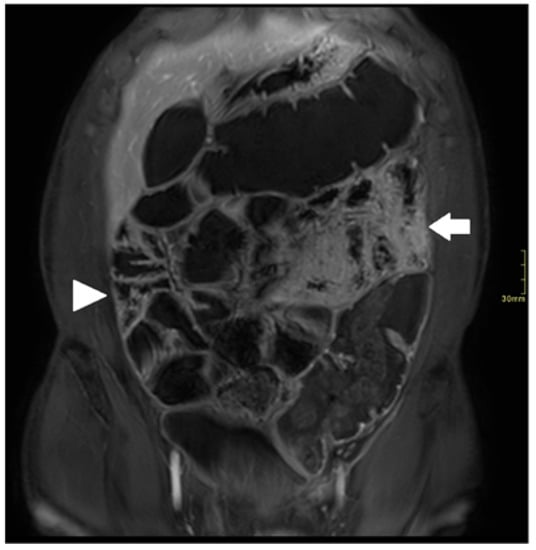 Diagnostics | | Challenges and Strategies to Optimising the Quality of Small Bowel Magnetic Resonance Imaging in Crohn&rsquo;s