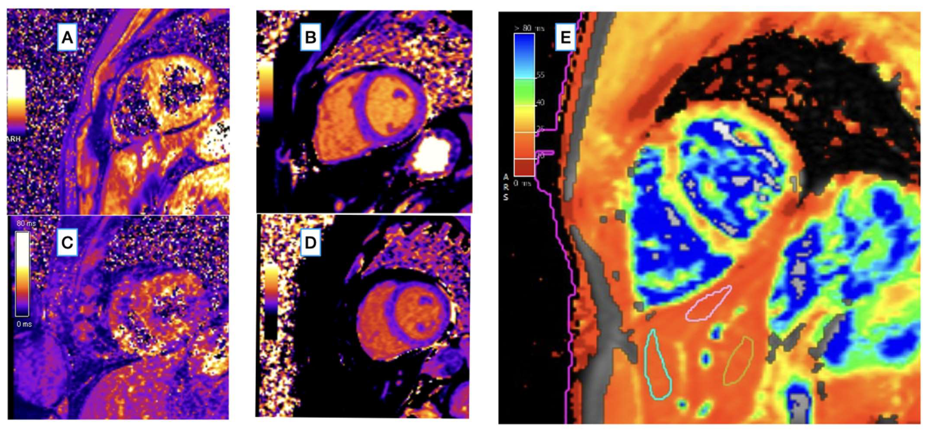 Diagnostics | Free Full-Text | Left Ventricular Function and Iron Loading  Status in a Tertiary Center Hemochromatosis Cohort&mdash;A Cardiac Magnetic  Resonance Study