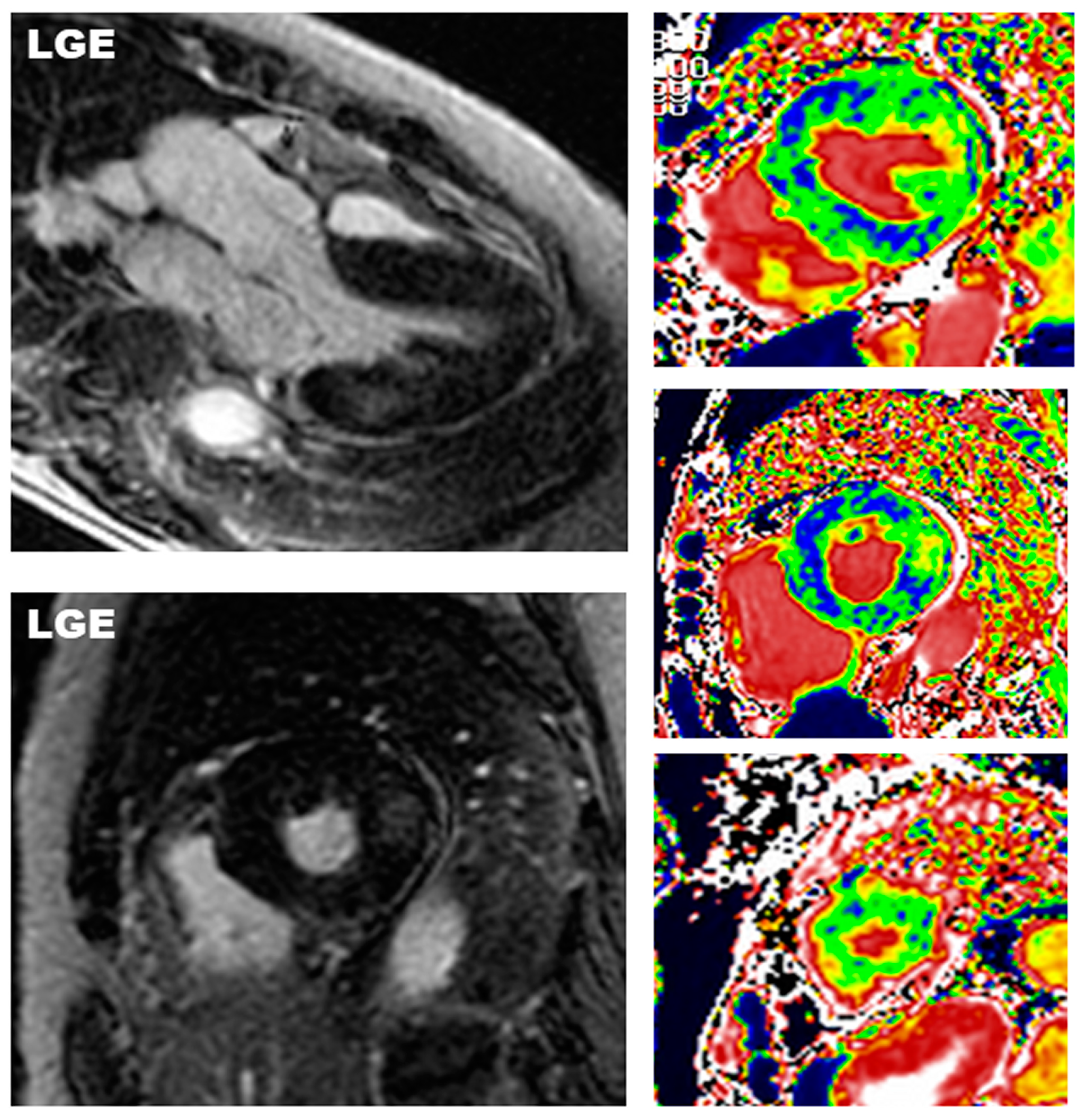 Diagnostics | Free Full-Text | Cardiac Magnetic Resonance in Fabry Disease:  Morphological, Functional, and Tissue Features | HTML