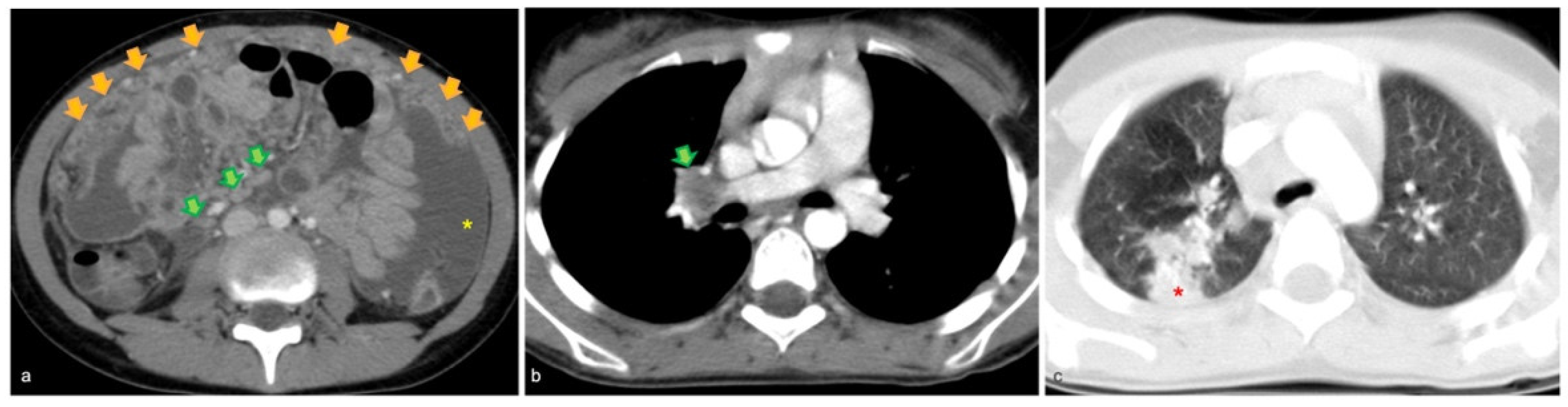 Omental cakes: unusual aetiologies and CT appearances | Insights into  Imaging | Full Text