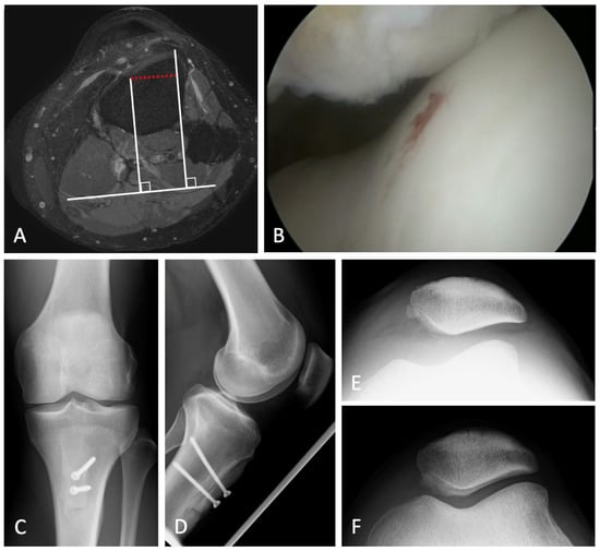 Neuromuscular Electrical Stimulation And Quadriceps Strength Following  Patellar Fracture And Open Reduction Internal Fixation Surgery: A Case  Report