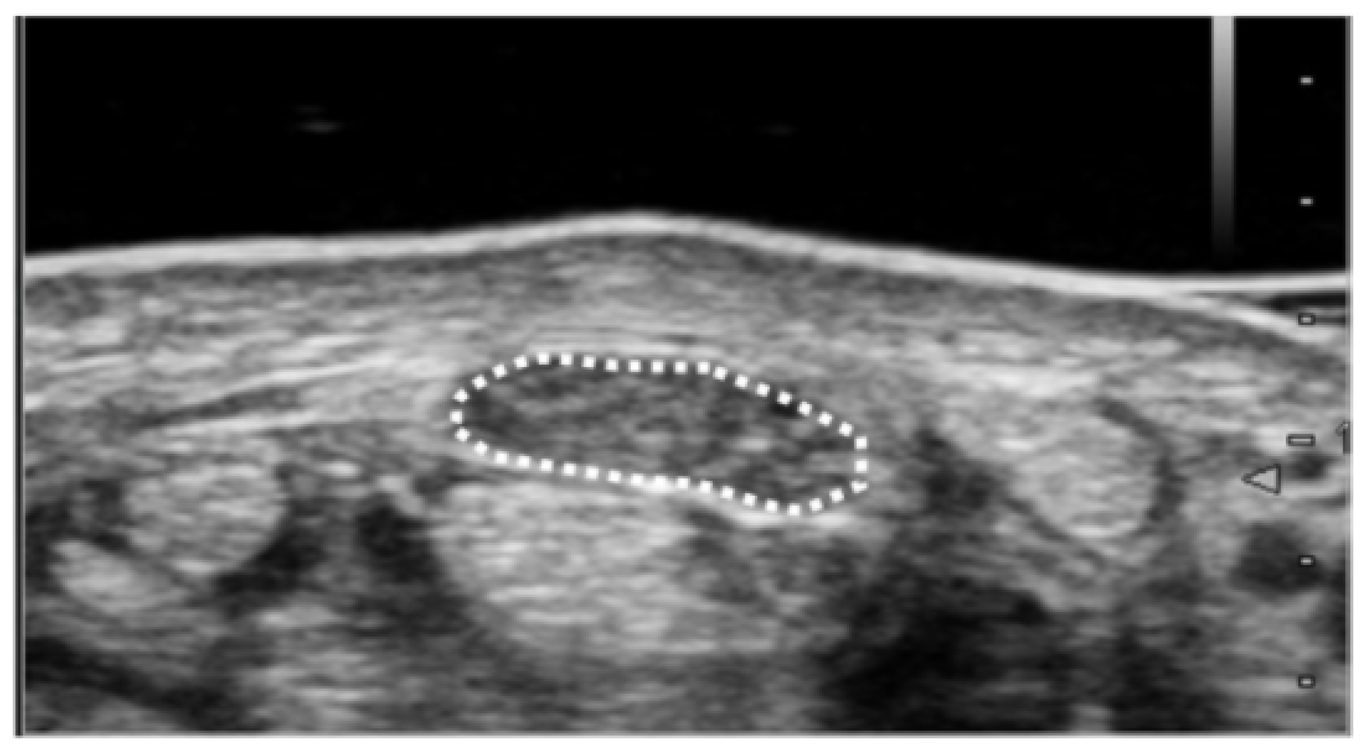 Ultrasound Study for Carpal Tunnel Syndrome - Upper East Side New