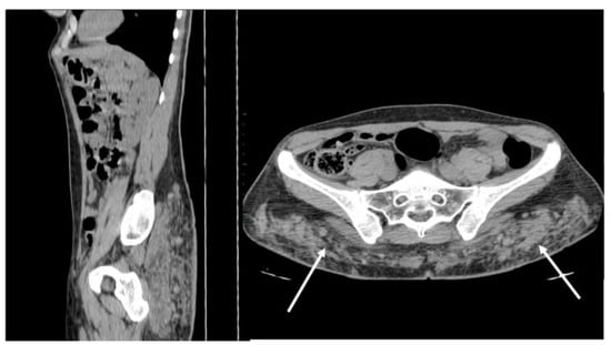 Diagnostics Free Full Text The Benign Side Of The Abdominal Wall A Pictorial Review Of Non 6615